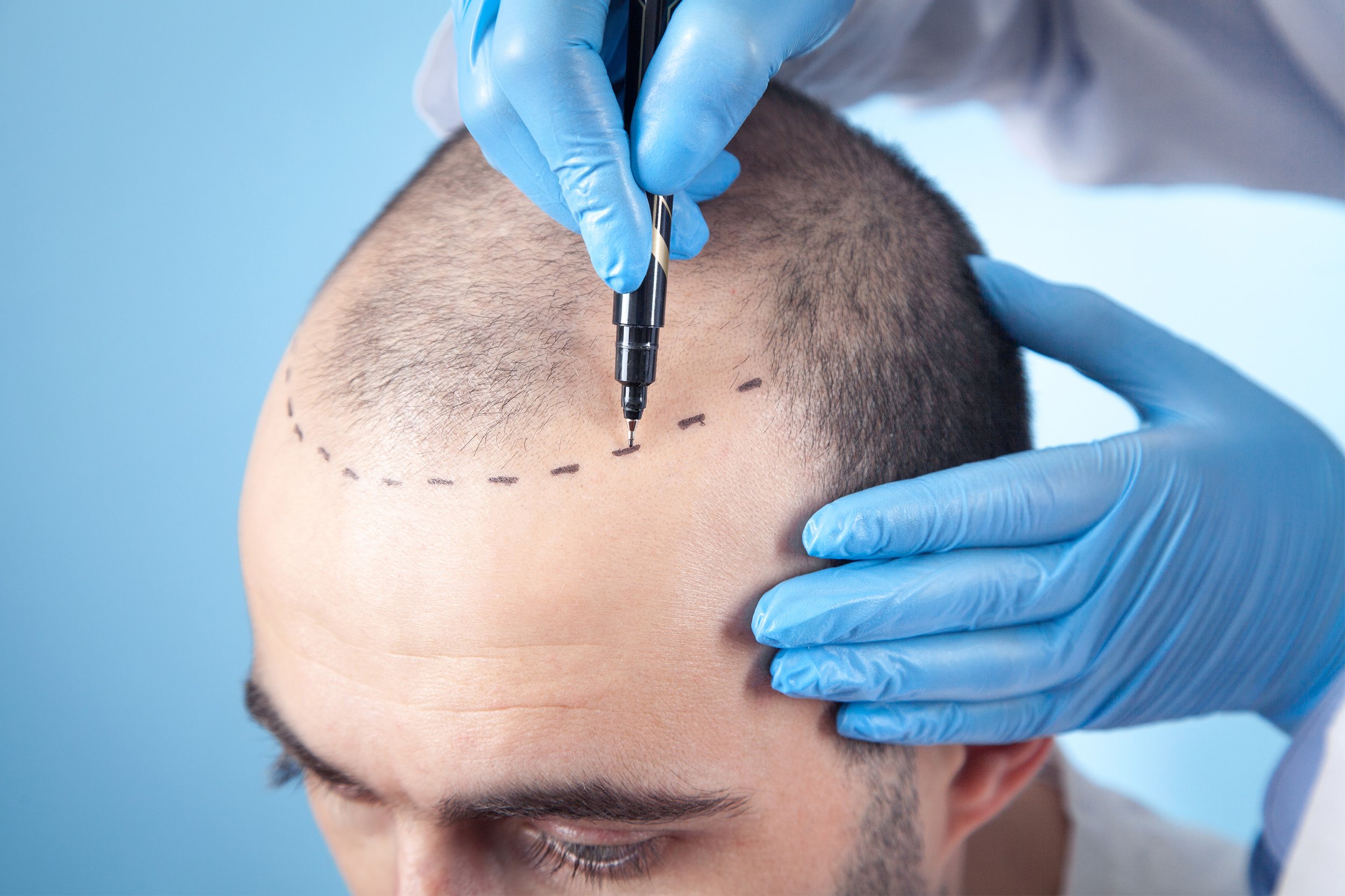 The Difference Between FUT and FUE Hair Transplants