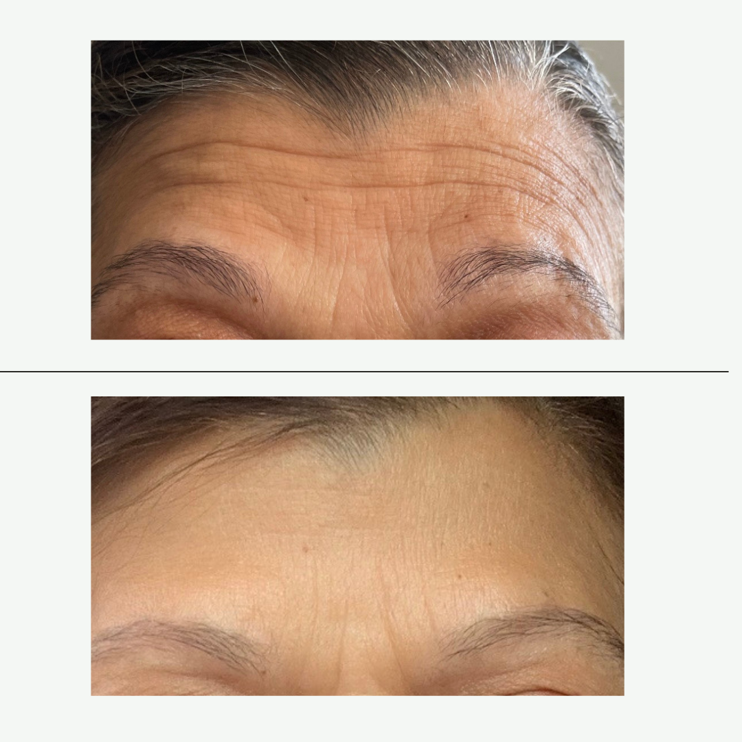 Side-by-side comparison of a person's forehead before and after a cosmetic treatment, showing smoother skin with fewer wrinkles in the after image.