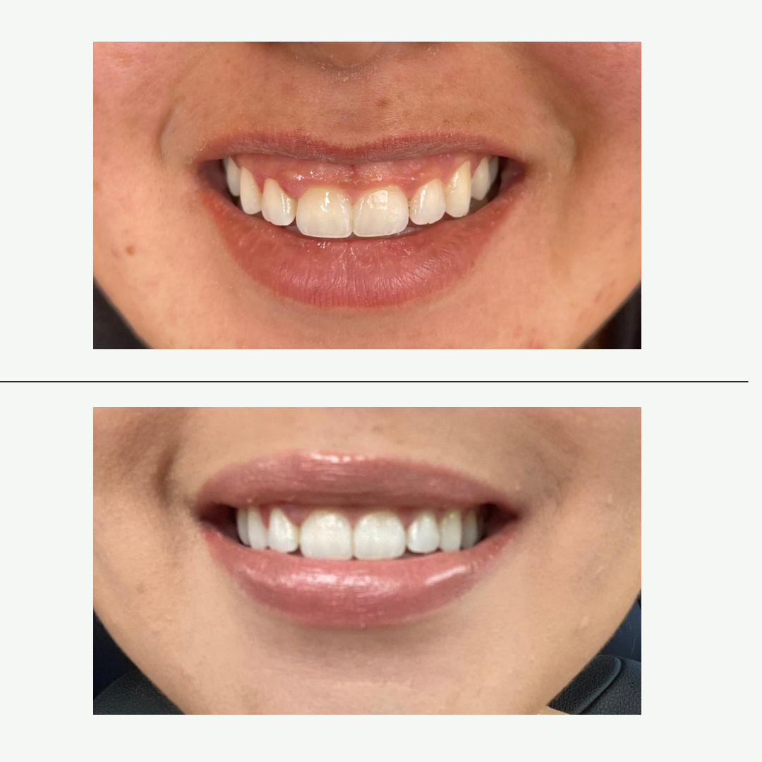 Close-up images of a person's smile, showing teeth before and after filler and botox, with the second smile appearing fuller and more aligned.