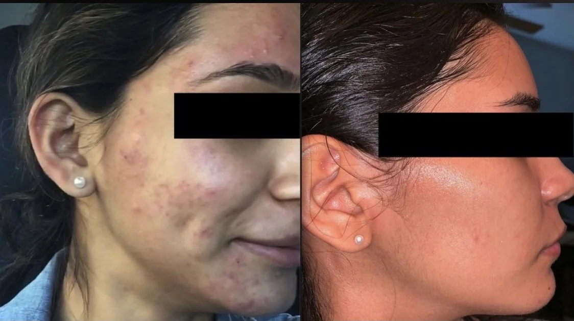 Hormonal Acne in Your 30s &amp; 40s: A San Francisco Acne Specialist's Complete Guide
