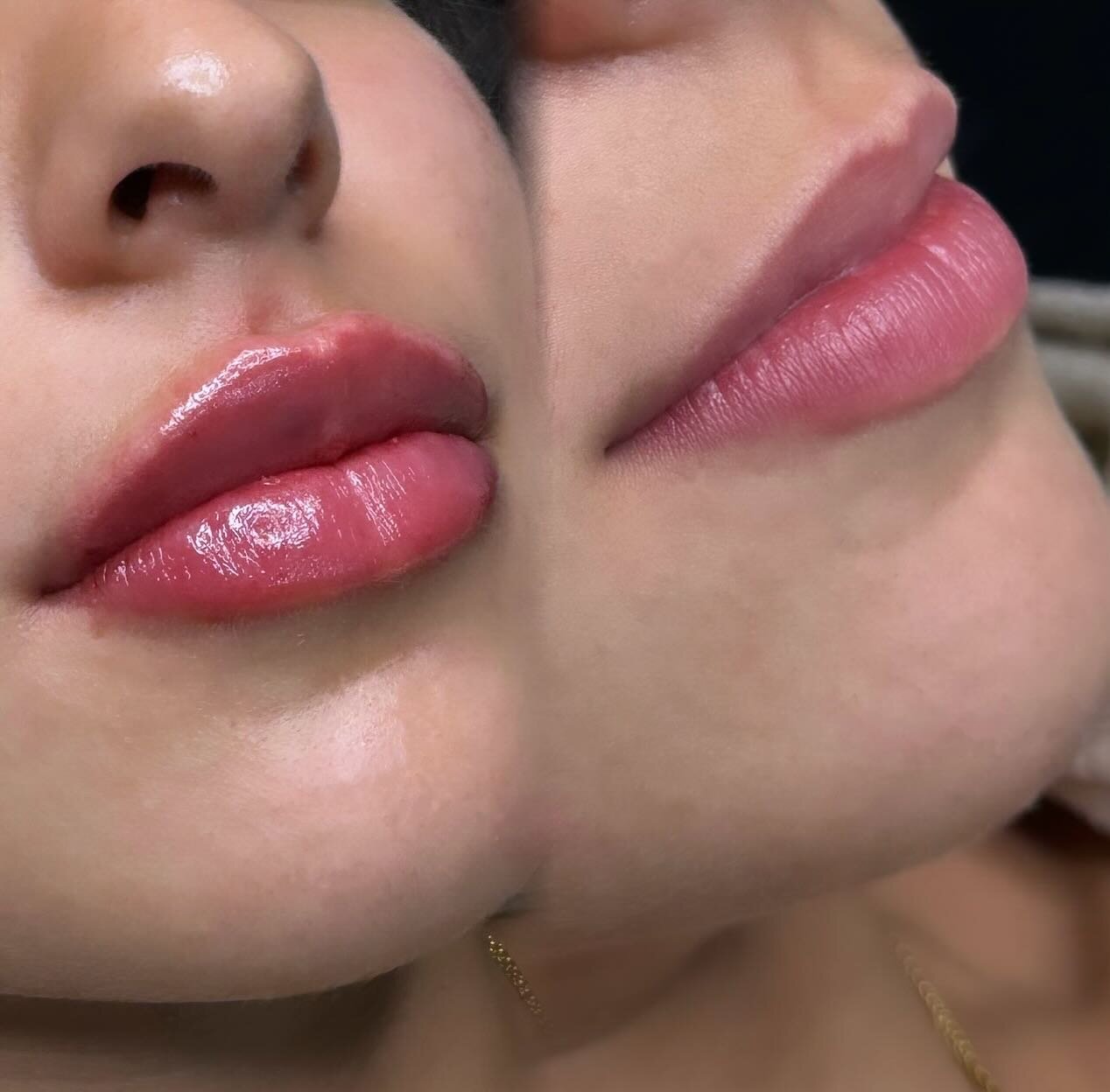 Show Stopper 🤤😍

Look at these sexy lips 🫦&hellip;. Now is the time to treat yourself with Valentines around the corner 💝 

Achieved using 1 syringe of Versa 💉
A nerve block was performed as well as Topical numbing for absolutely zero discomfort