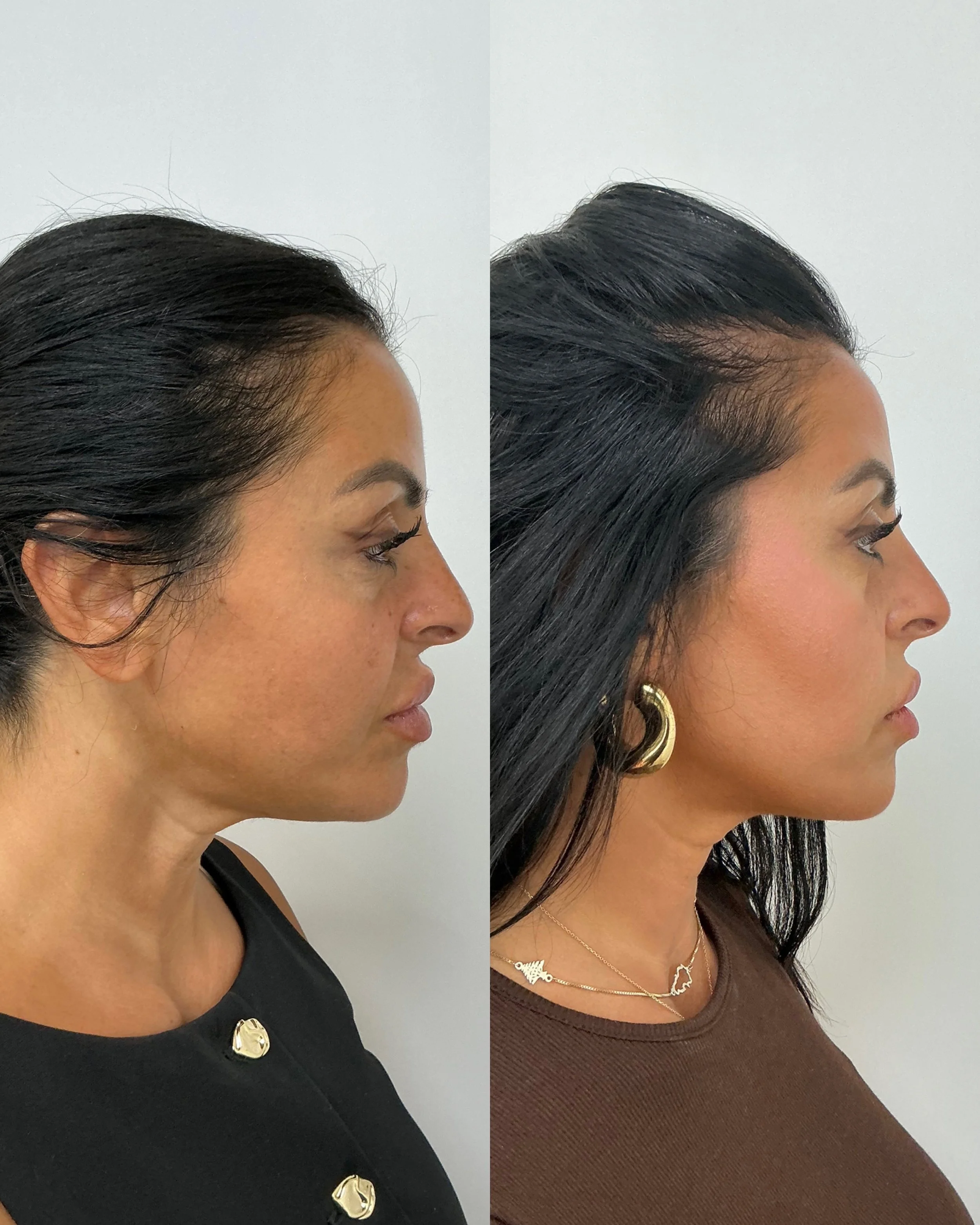 before and after xerf treatment