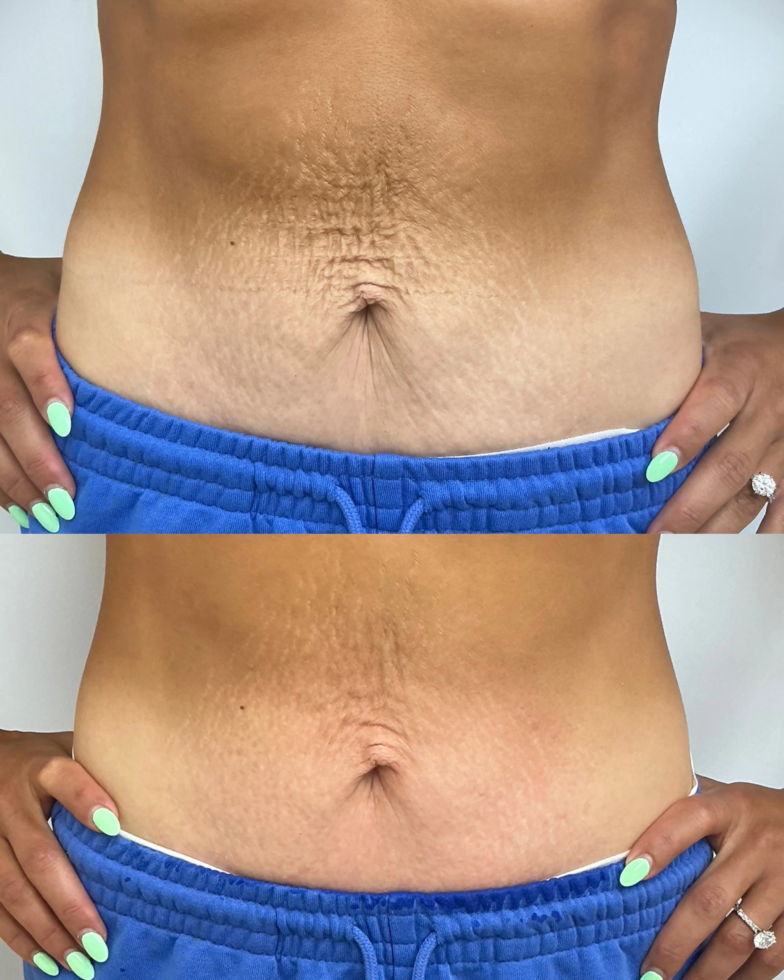 xerf treatment before and after