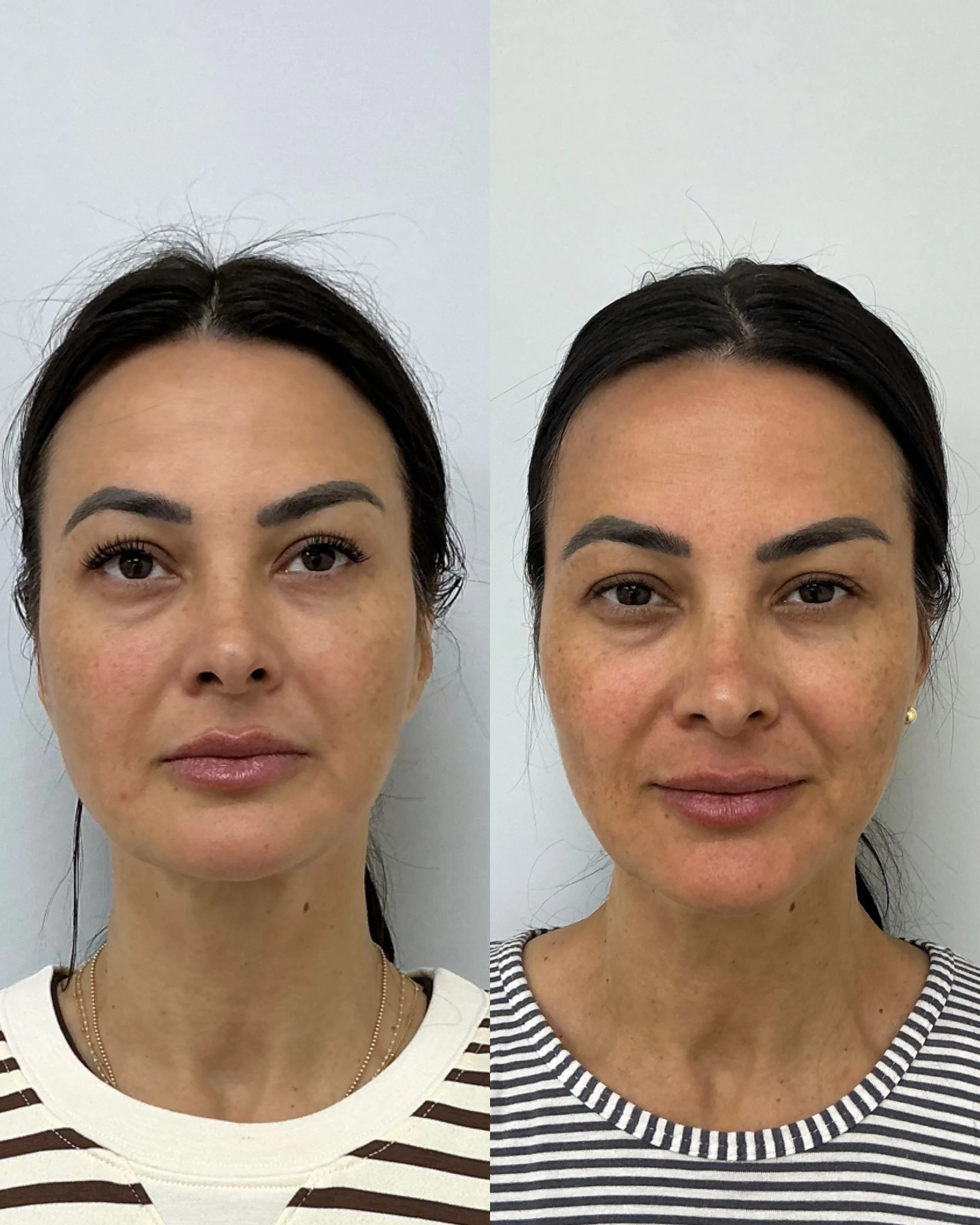 xerf treatment near me