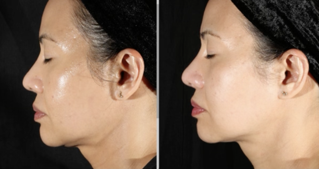 xerf skin tightening