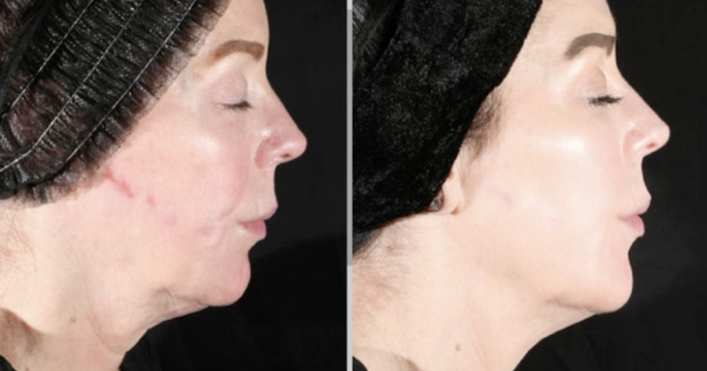 skin tightening michigan