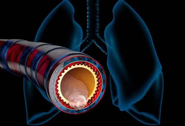 Do I Have Mucus Plugs?