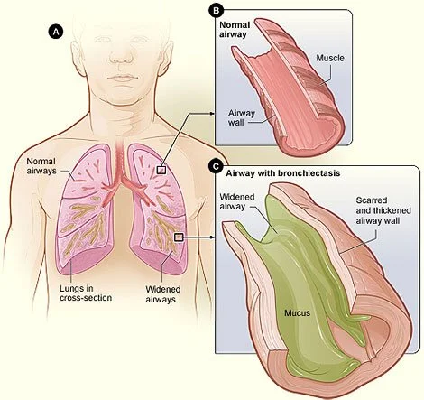 Chest Infection Examples How To Prevent Another Chest Infection — COPD Online - Donald A. Mahler ...