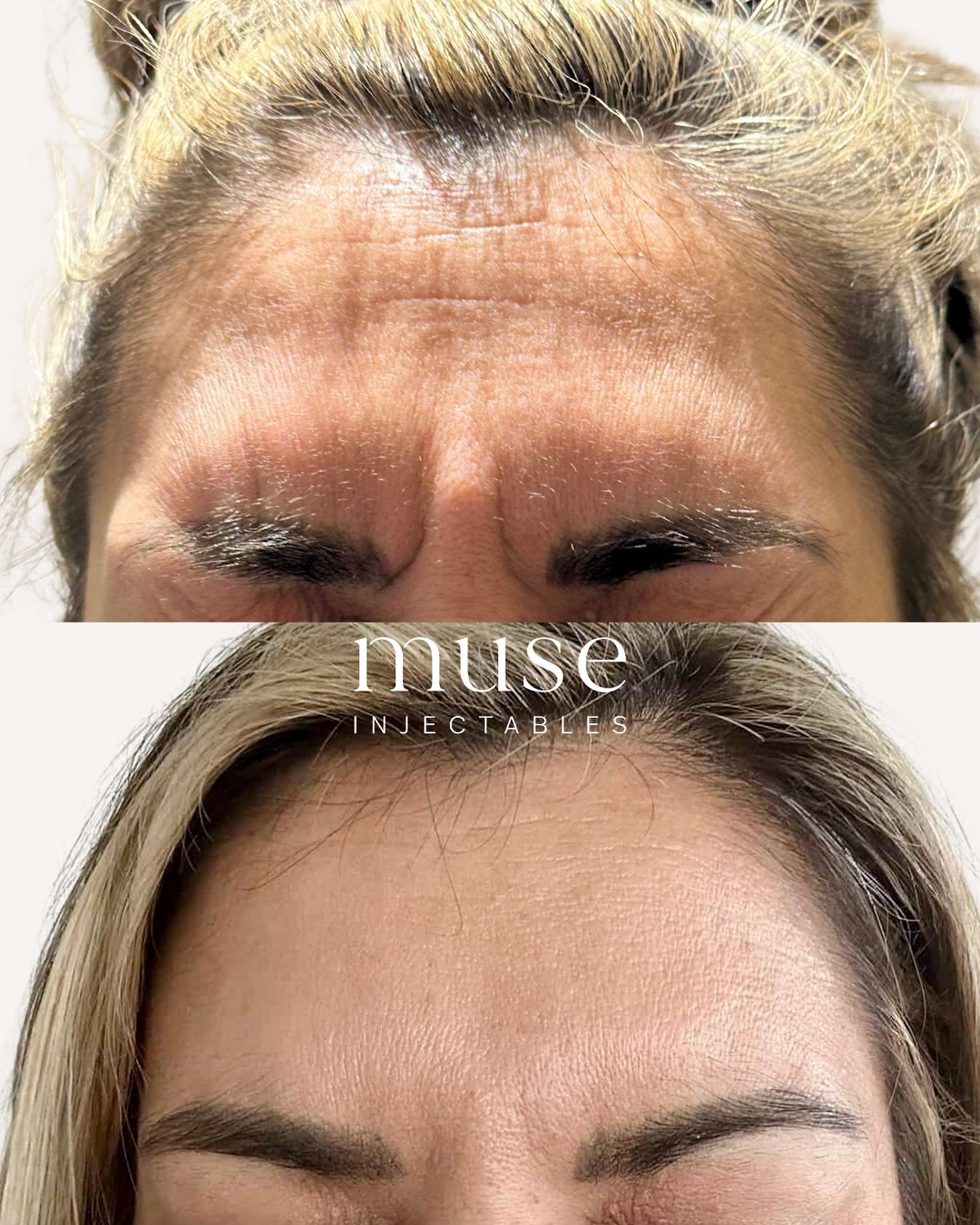 Frown before and after 🤭
Client was frowning in both photos
—
Mandatory Statement
Botulinum toxin injections are Prescription Medicines for the treatment of frown lines, horizontal forehead lines and crow’s feet round the eyes. Botu