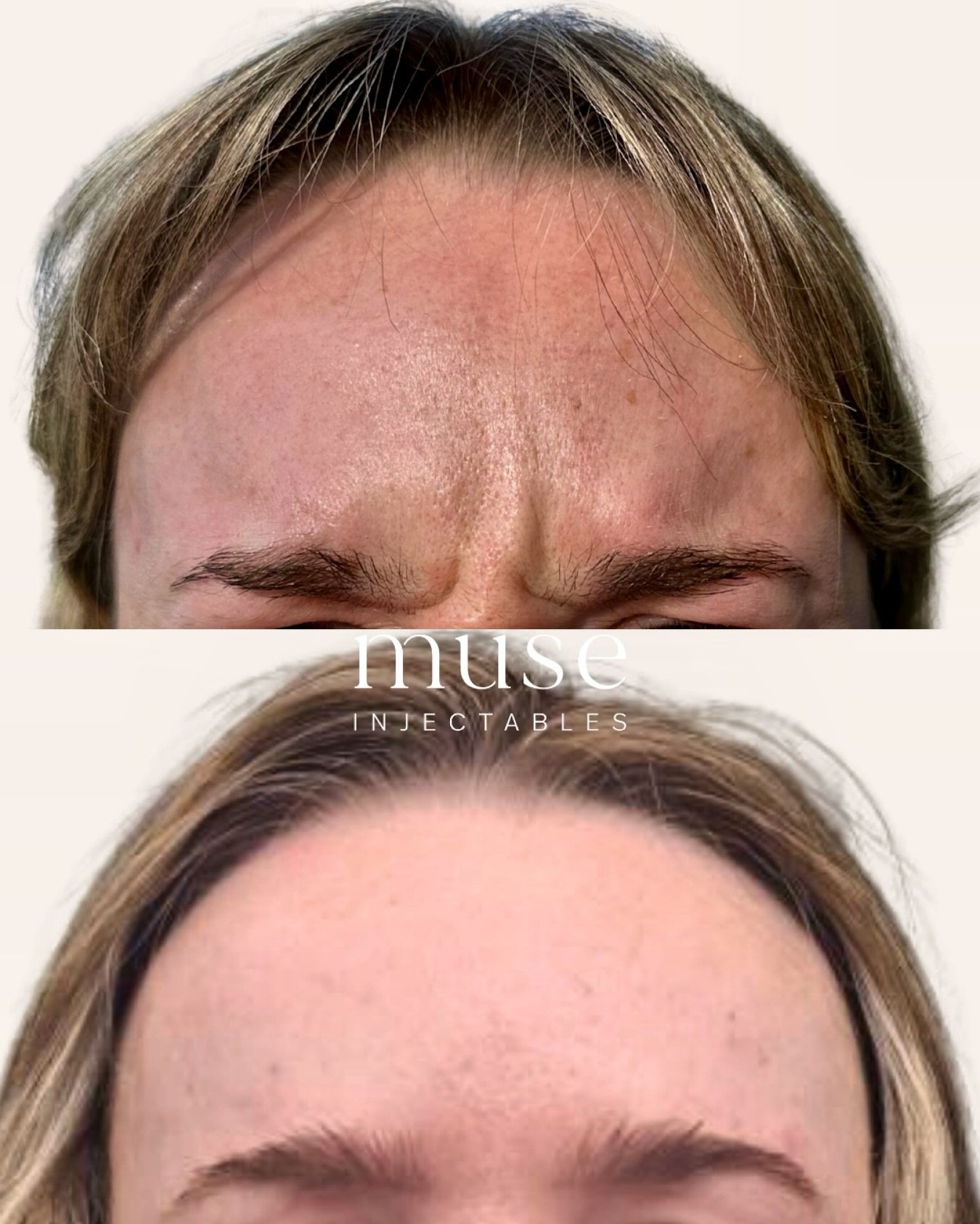Before ⬇️ After
Anti wrinkle treatment to the frown 😍
Photos taken 2 weeks apart
—
Mandatory Statement
Botulinum toxin injections are Prescription Medicines for the treatment of frown lines, horizontal forehead lines and crow’s fe