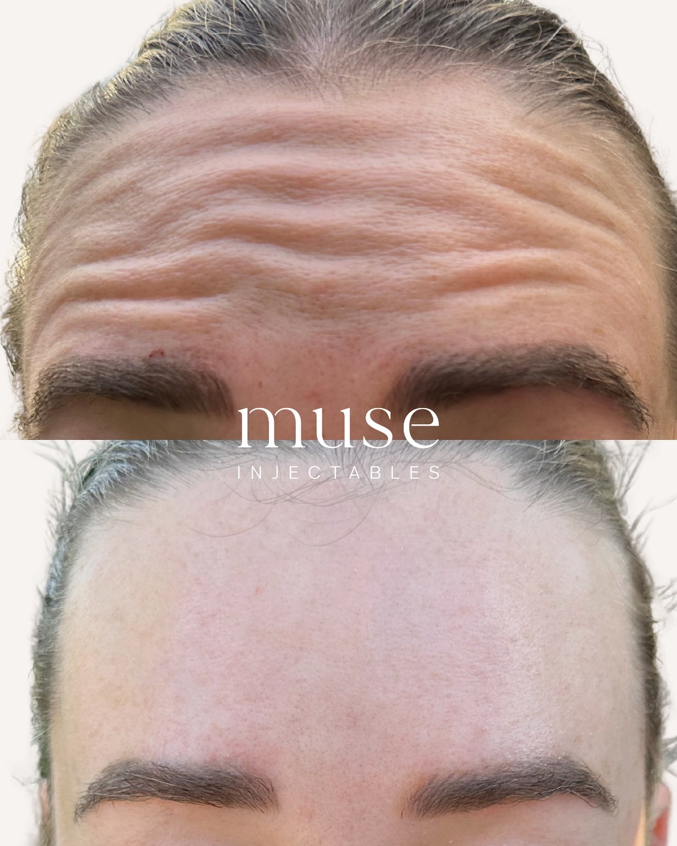 Forehead before and after 😍
Photos taken 2 weeks apart, eyebrows raised up in both photos.
—
Mandatory Statement
Botulinum toxin injections are Prescription Medicines for the treatment of frown lines, horizontal forehead lines and crow&r