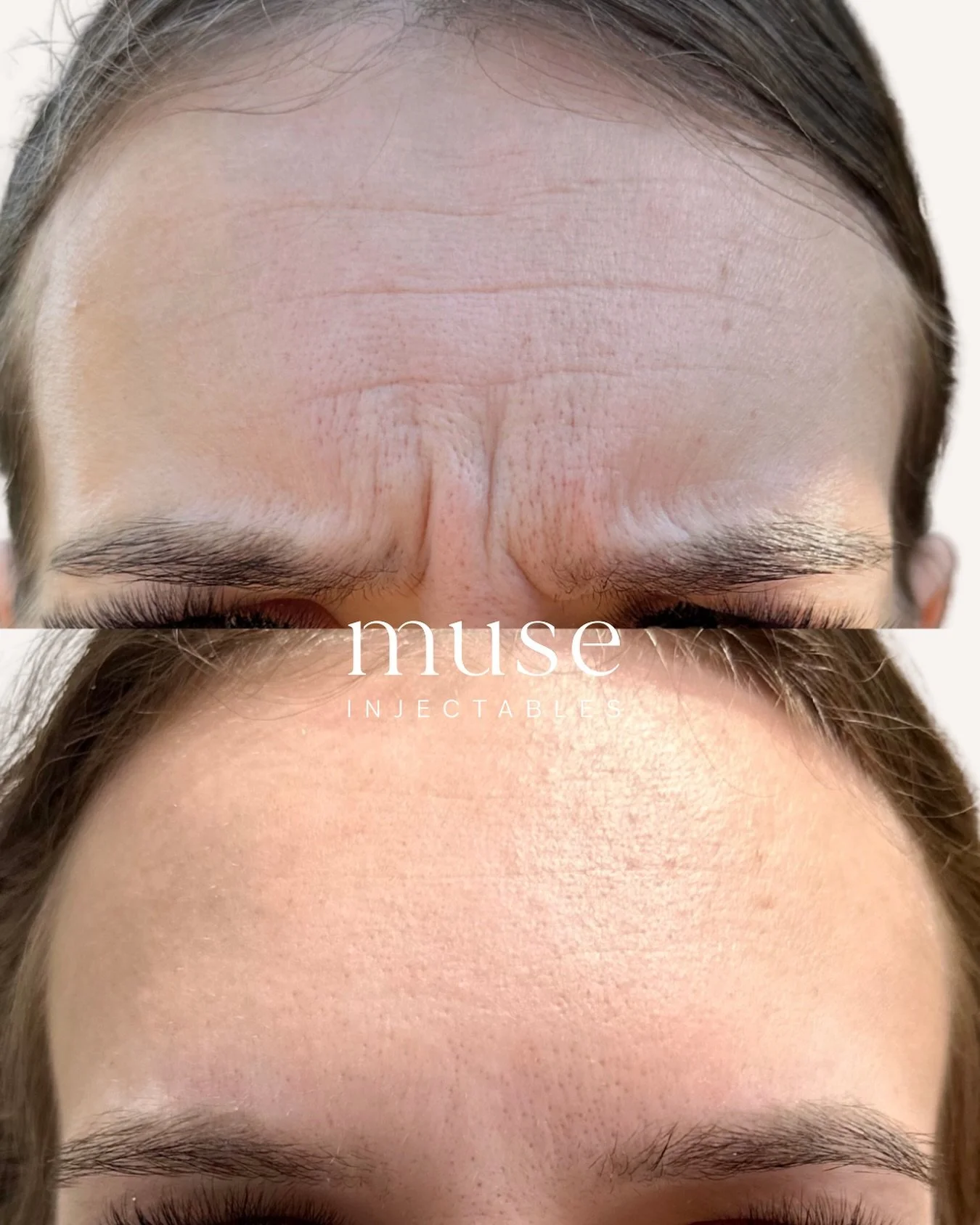 Before &amp; after results of a frown line treatment with anti-wrinkle injections 💅

Psa if you book now- your next treatment will be right in time for Christmas 🎄😅

&mdash;

Mandatory Statement

Botulinum toxin injections are Prescription Medicin