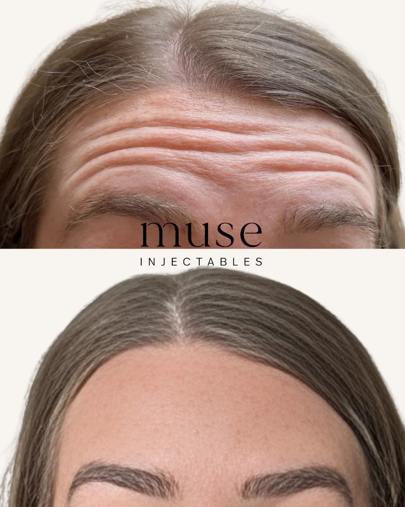 A little refresh, just in time for summer ☀️

Our goal was a fresher, more relaxed appearance while keeping everything natural and balanced

&mdash;

Mandatory Statement 

Botulinum toxin injections are Prescription Medicines for the treatment of fro