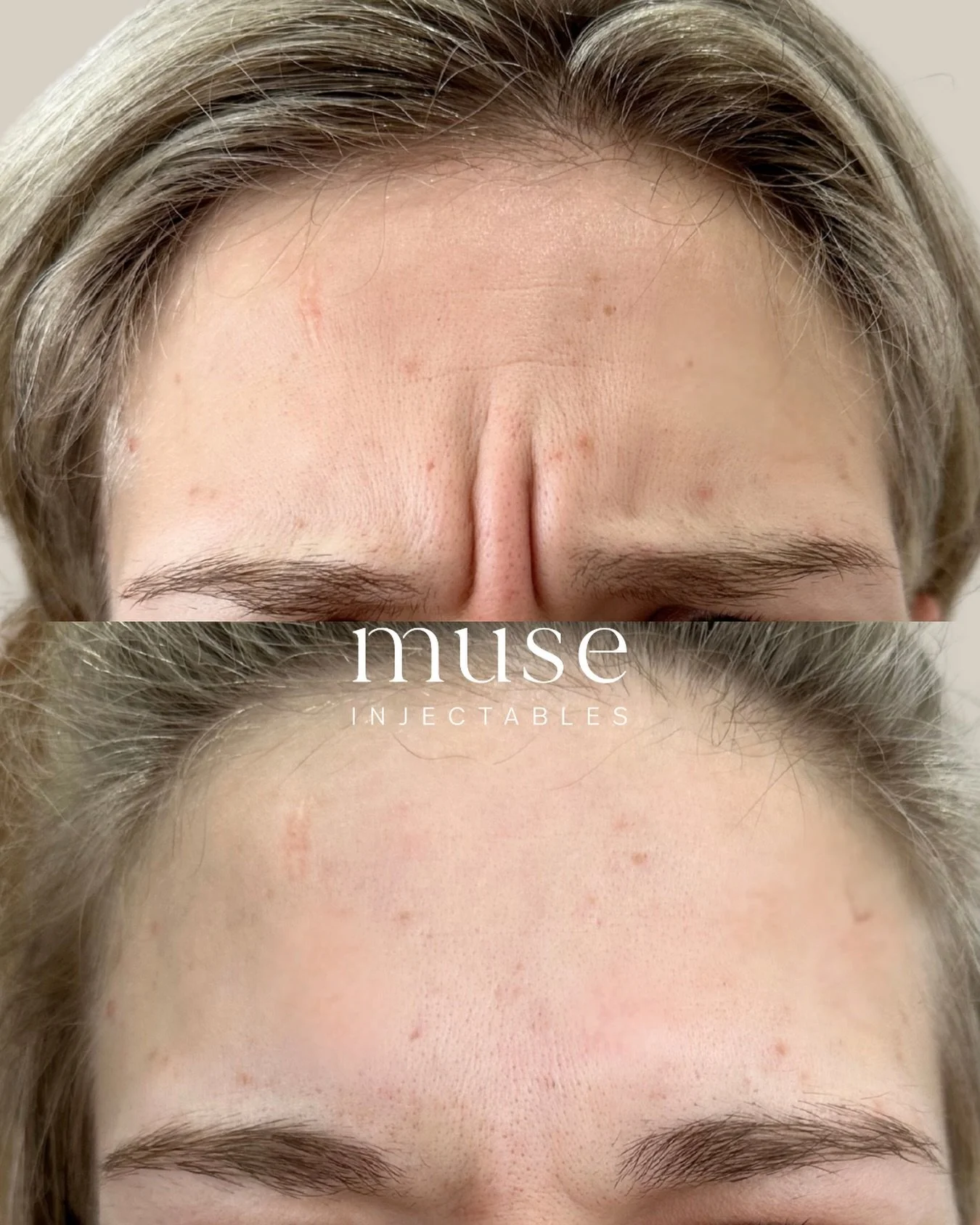 Before &rarr; After 

Frown lines form from repeated muscle movement over time. Botox works by relaxing these muscles, helping smooth lines and prevent them from deepening.

Results shown at 2 weeks. 

&mdash;

Mandatory Statement 

Botox&reg;, Presc