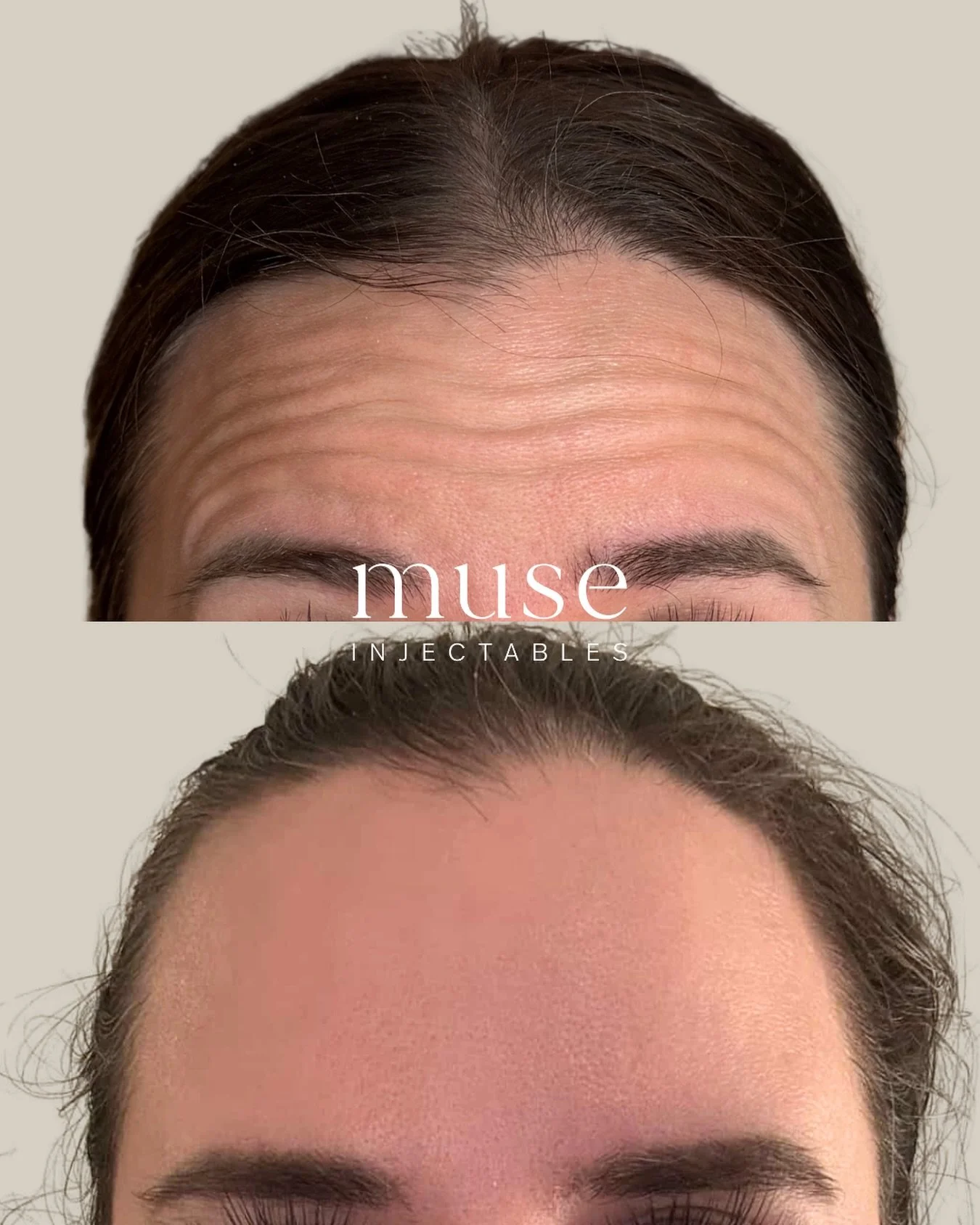 Upper face anti-wrinkle treatments gently relax the muscles that create expression lines, leaving skin smoother and more refreshed. 

The results look natural &mdash; you&rsquo;ll still look like you, just well-rested and rejuvenated. 

Minimal downt