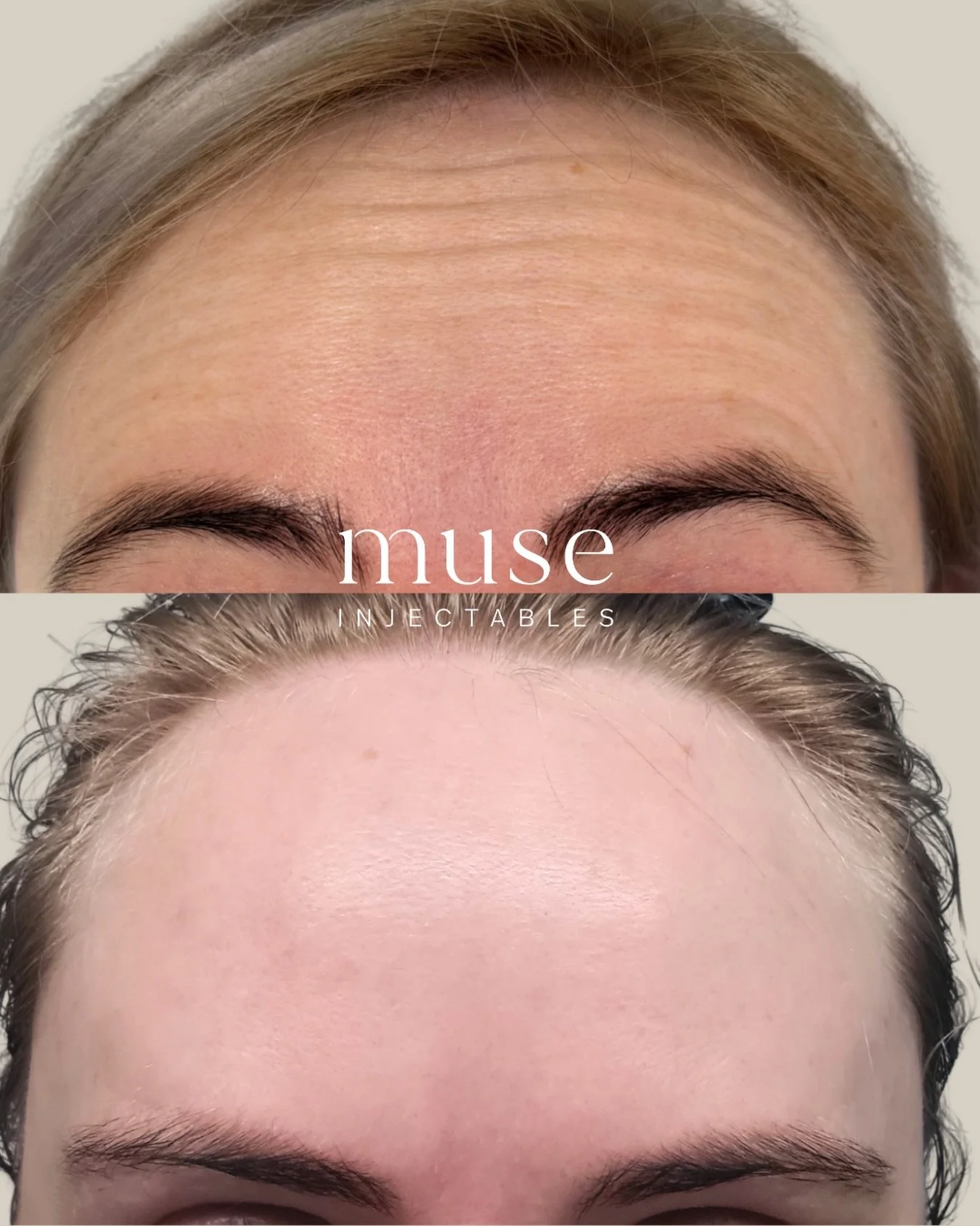 Anti-wrinkle treatment to forehead 💉 

Photos taken 2 weeks apart 

&mdash;

Mandatory Statement 

Botulinum toxin injections are Prescription Medicines for the treatment of frown lines, horizontal forehead lines and crow&rsquo;s feet round the eyes