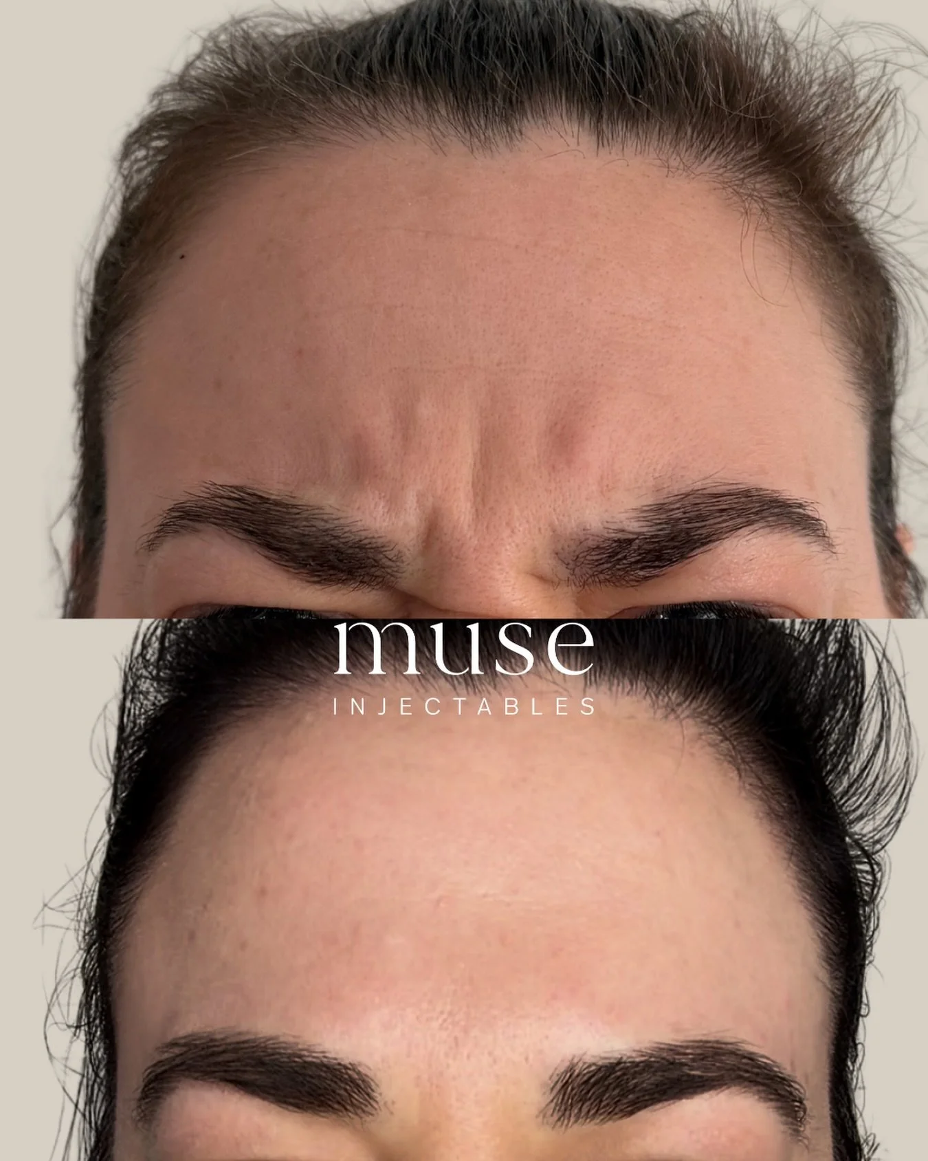 Softening the frown area can help create a more refreshed, relaxed appearance while still keeping natural movement 

This treatment works by temporarily reducing muscle activity that contributes to dynamic lines between the brows , commonly caused by