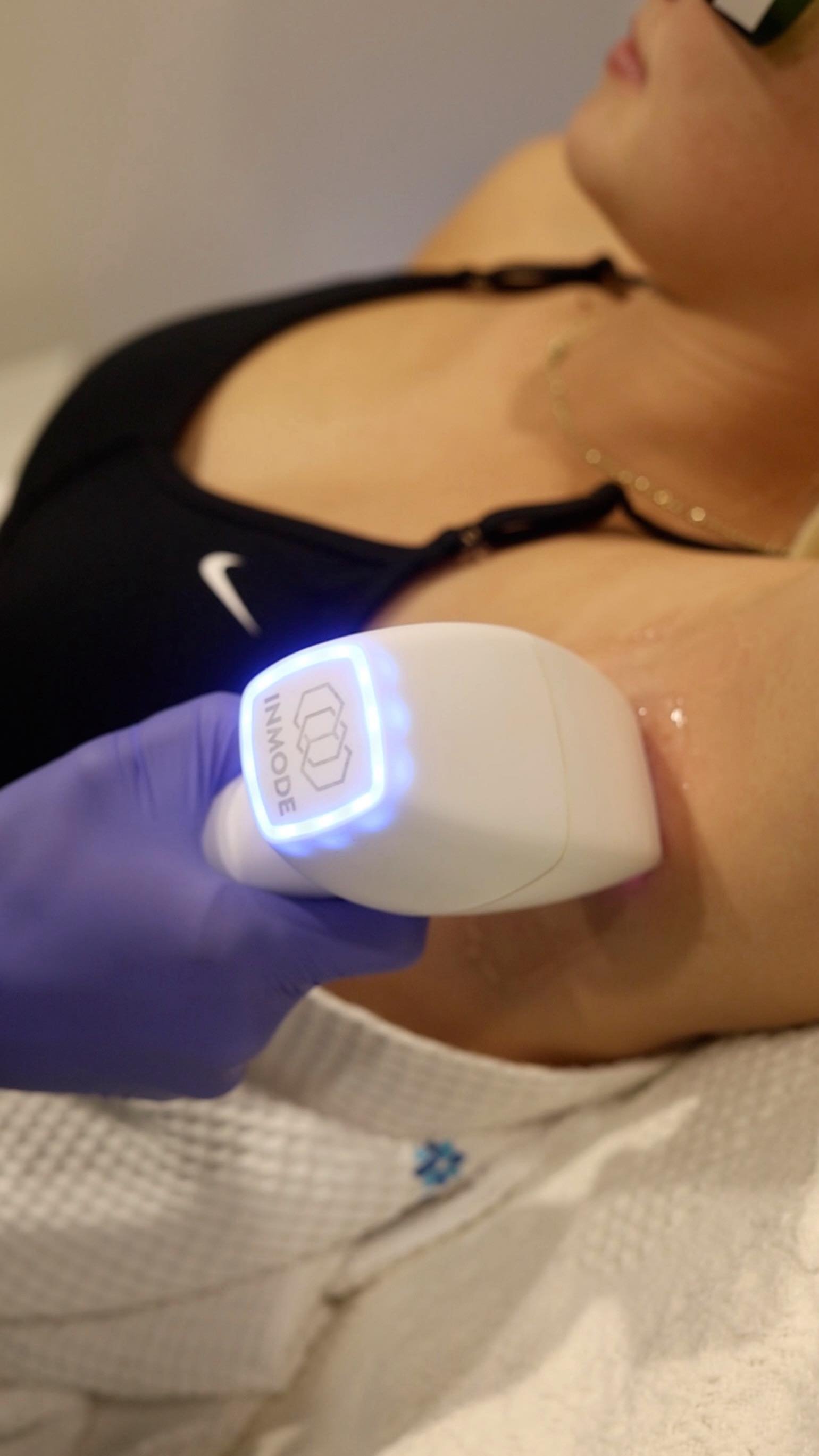 Ditch the razor and stay swimsuit-ready all summer long with laser hair removal! ☀️
With InMode Laser Hair Removal, you can enjoy smoother skin with long lasting results! And did we mention no razor burn, no ingrowns, and no downtime!
This advance