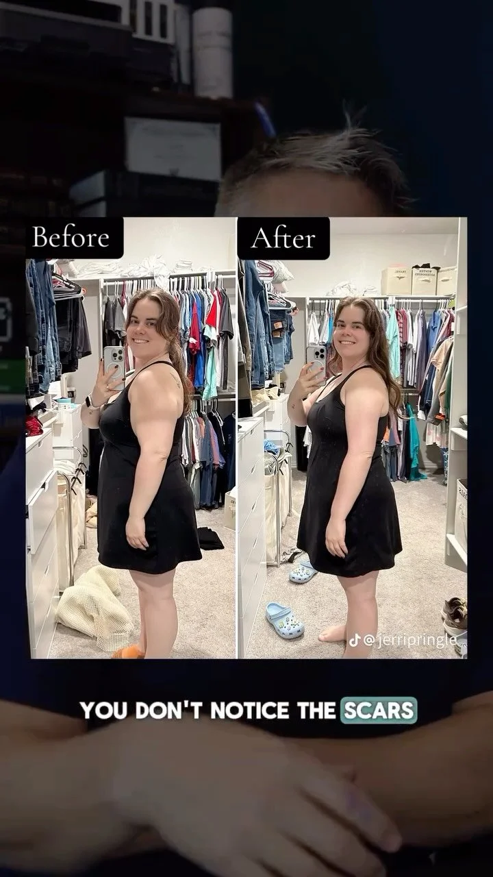 An Inside Look at an Arm Lift Transformation! Watch until the end for before & after pictures! 💪
We’re so excited to share this behind-the-scenes look at one of our amazing patient’s arm lift journey! From surgery day to her one-mon