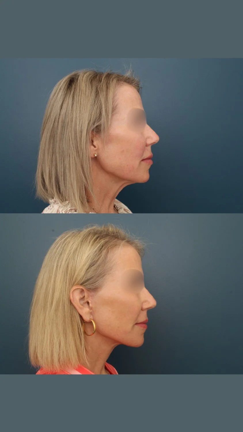 What makes a WOW facelift truly ‘wow’? Watch as Dr. Stubbs breaks it down!
1️⃣ Tighten the Skin
2️⃣ Replace Lost Volume
3️⃣ Refine Skin Architecture
With his signature approach to the deep plane facelift, Dr. Stubbs goes beyond the bas
