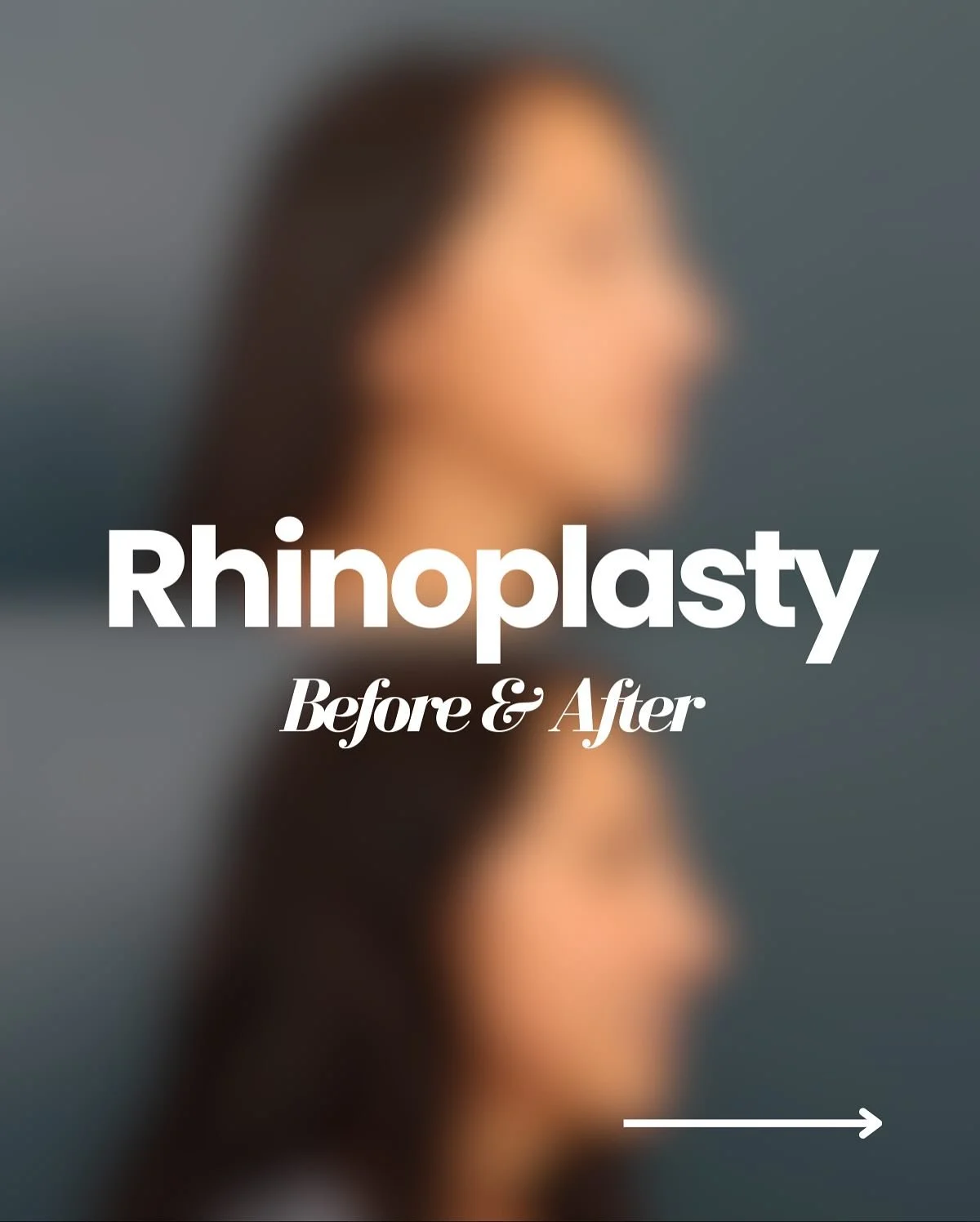 Rhinoplasty procedures are among the most intricate in facial aesthetics &mdash; blending surgical precision with artistic vision to achieve natural, balanced results. 👃

Swipe to see how subtle refinement can create truly dramatic results!

#rhinop