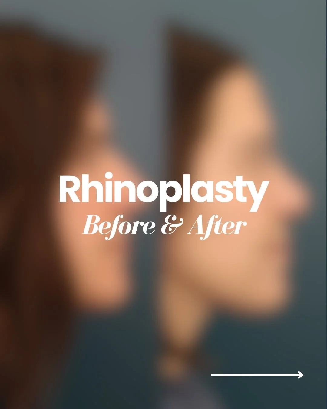 A refined profile with natural looking results! 

Subtle adjustments to the bridge and tip can significantly improve facial harmony when viewed from the side. This result reflects a customized approach tailored to the patient&rsquo;s anatomy and goal