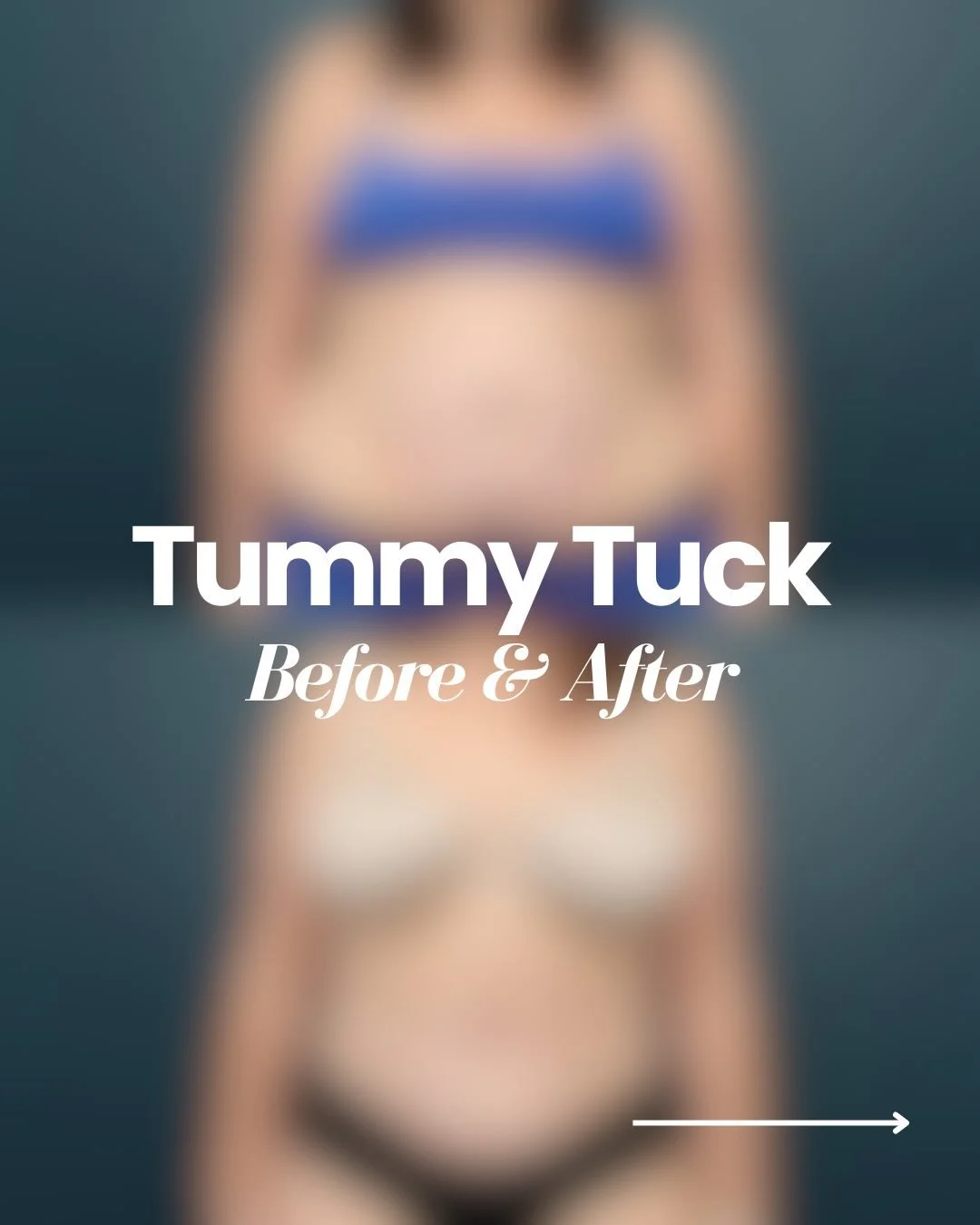 Check out this patient&rsquo;s stunning results! 👀

A tummy tuck is a procedure in which we restore your core after pregnancy, weight loss, or years of stretched skin that won&rsquo;t bounce back on its own. 

This procedure is ideal for patients