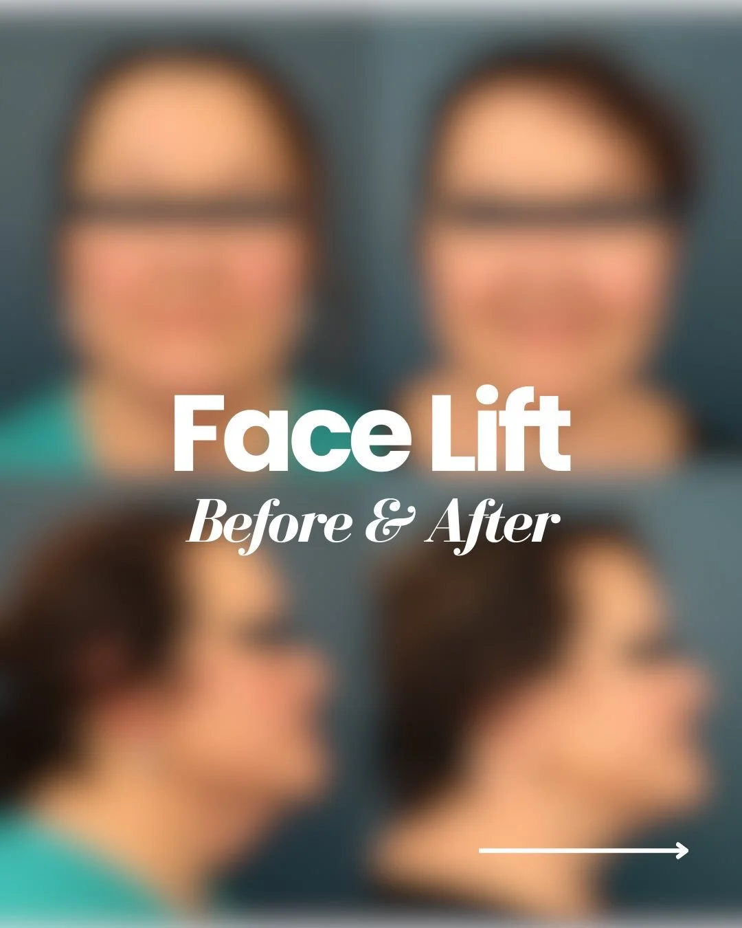 Check out this patient&rsquo;s facelift results! 👀

This procedure has restored structure, smoothed laxity, and improved jawline definition &mdash; without looking pulled or overdone. 

If you&rsquo;re starting to notice heaviness through the lower 