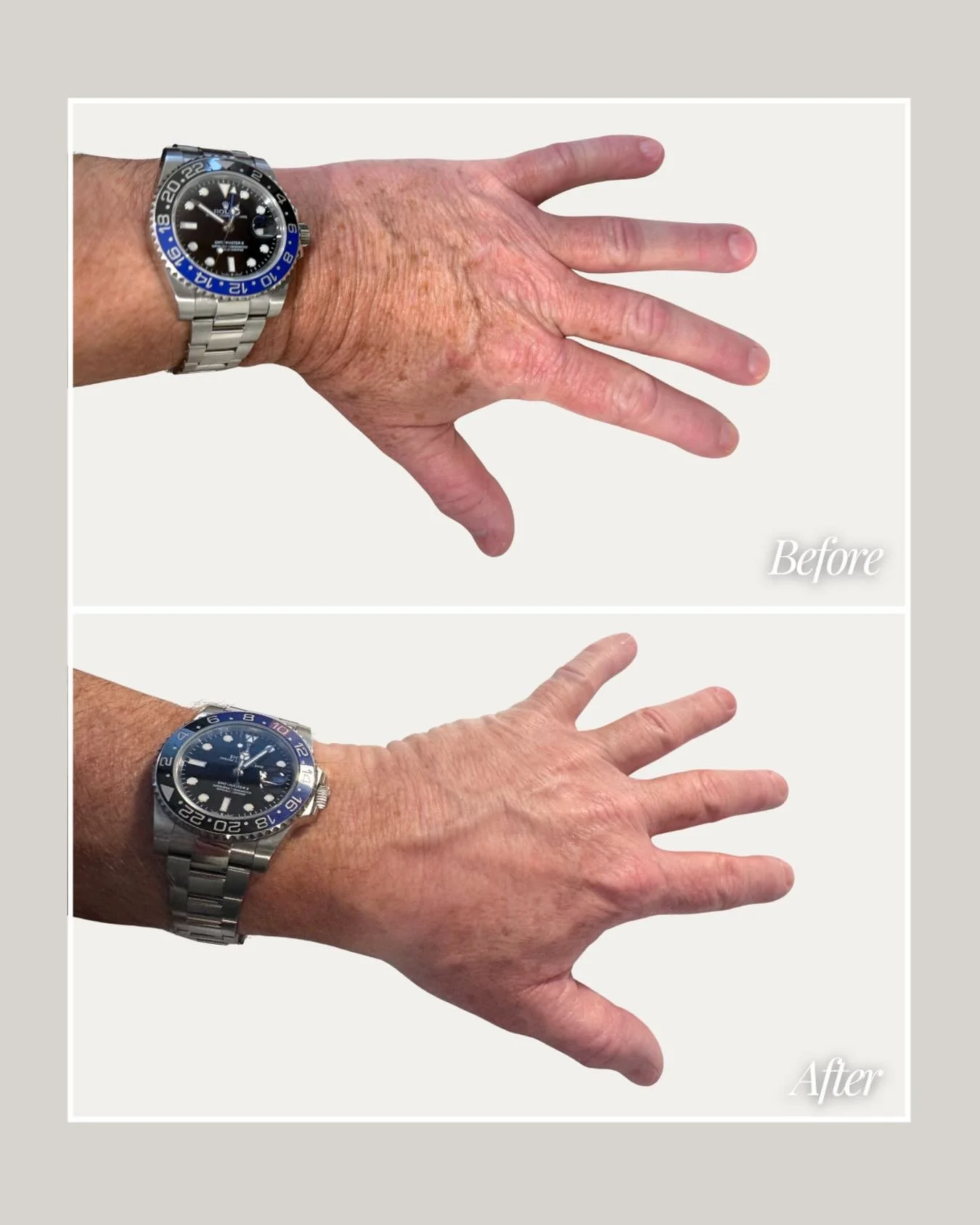 Would you believe us if we told you that this is just after one treatment of the IPL? 👀 Our hands are often one of the first places to show signs of aging &mdash; sun spots, uneven tone, and texture changes can all add up over time! 

This treatment