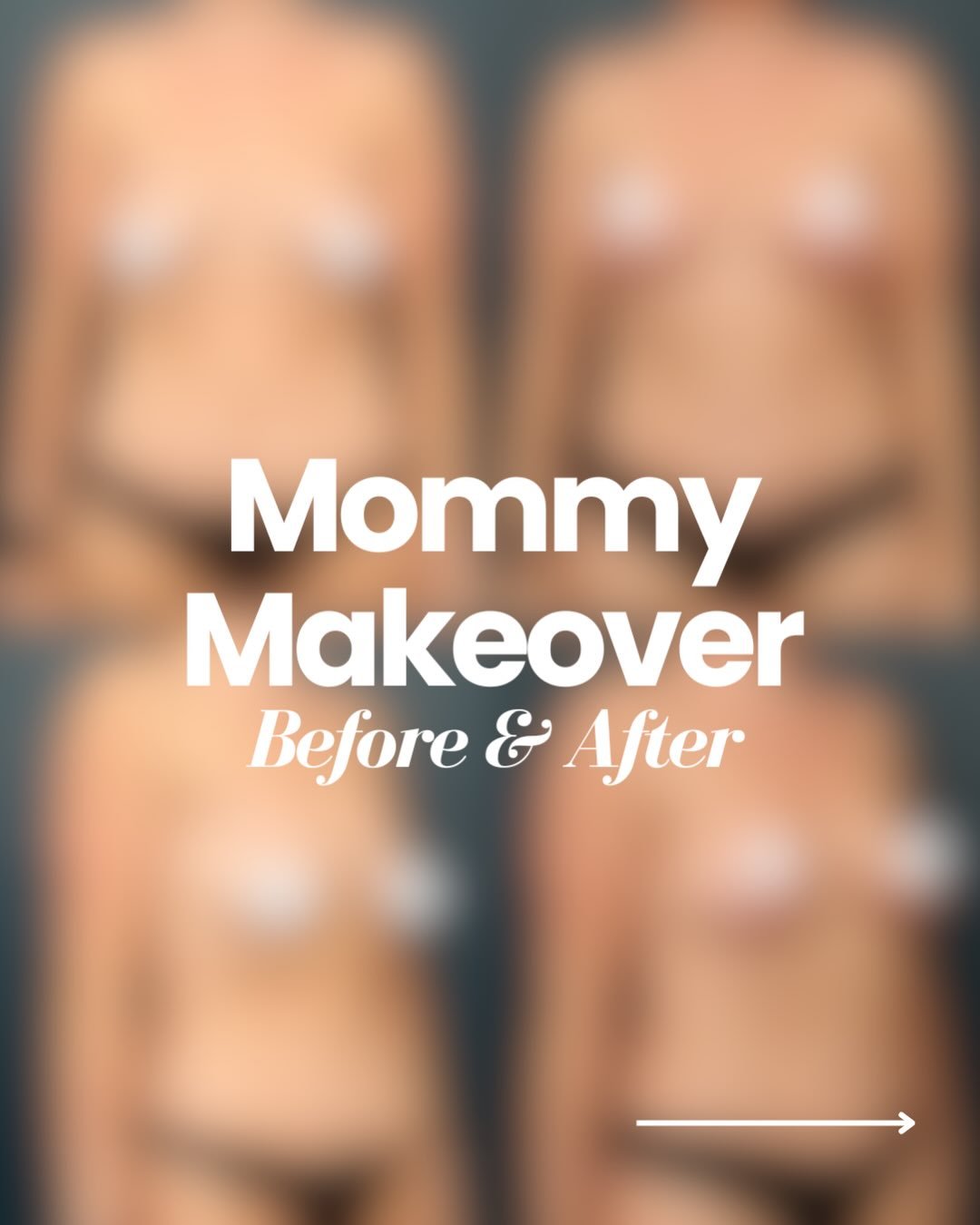 Swipe to see this patient&rsquo;s stunning Mommy Makeover results! 👀

Sometimes your body can change in ways that diet and exercise alone can&rsquo;t always address. This mommy makeover was tailored to restore areas that have changed over time while