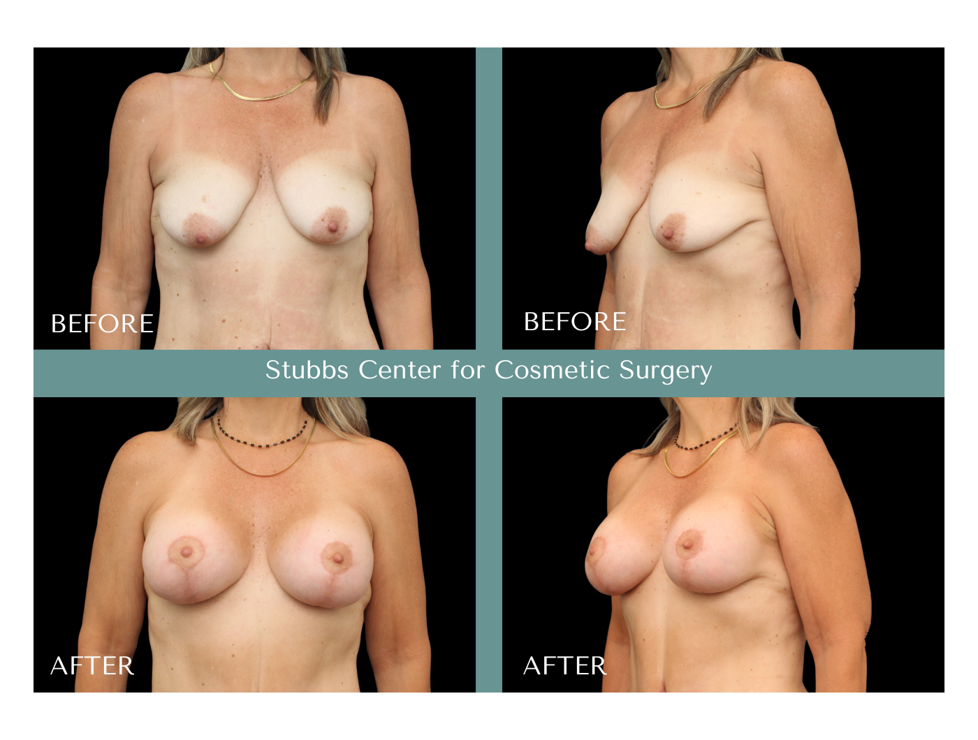 breast lift.png