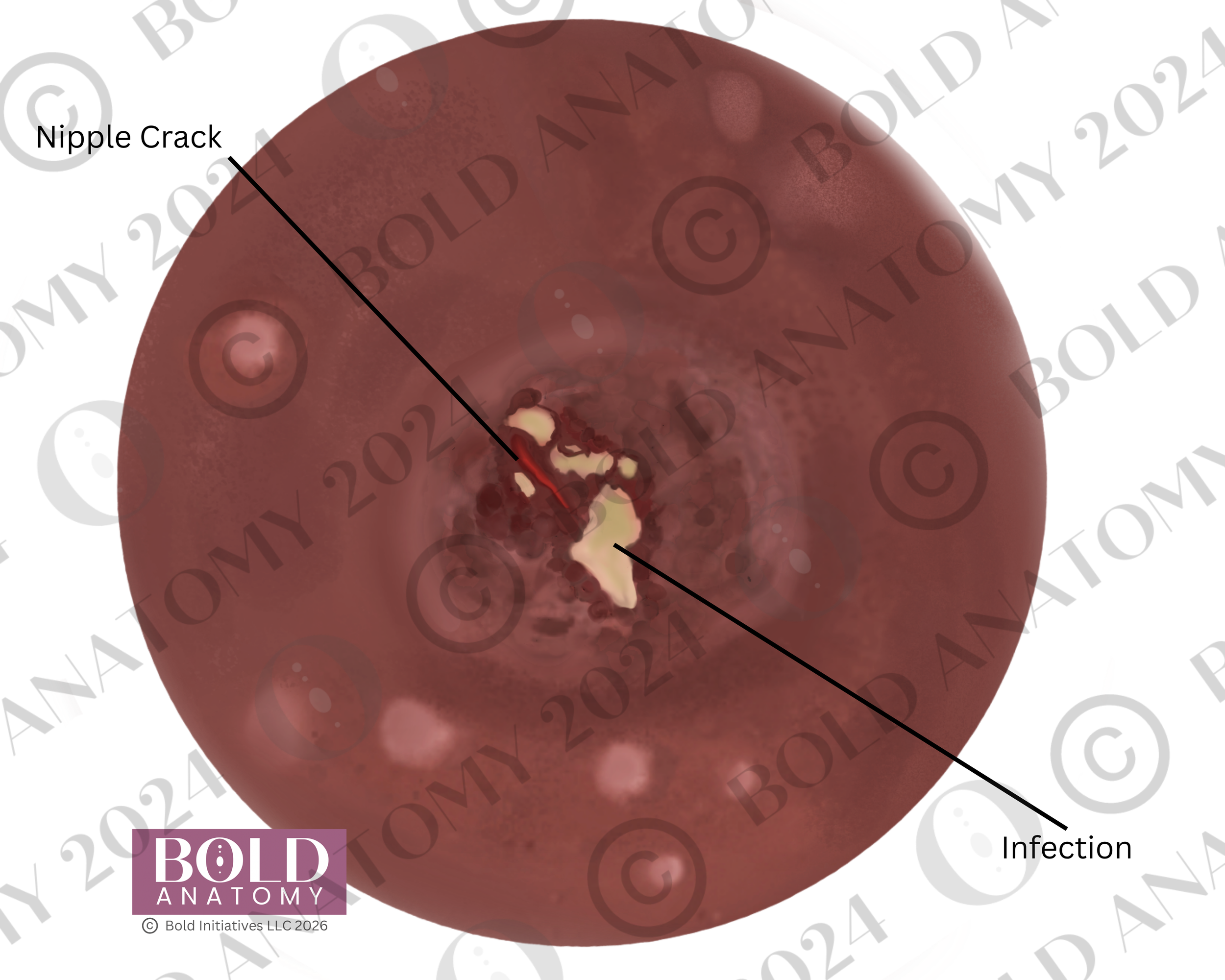 Labeled Nipple Crack,  Medium Dark.png
