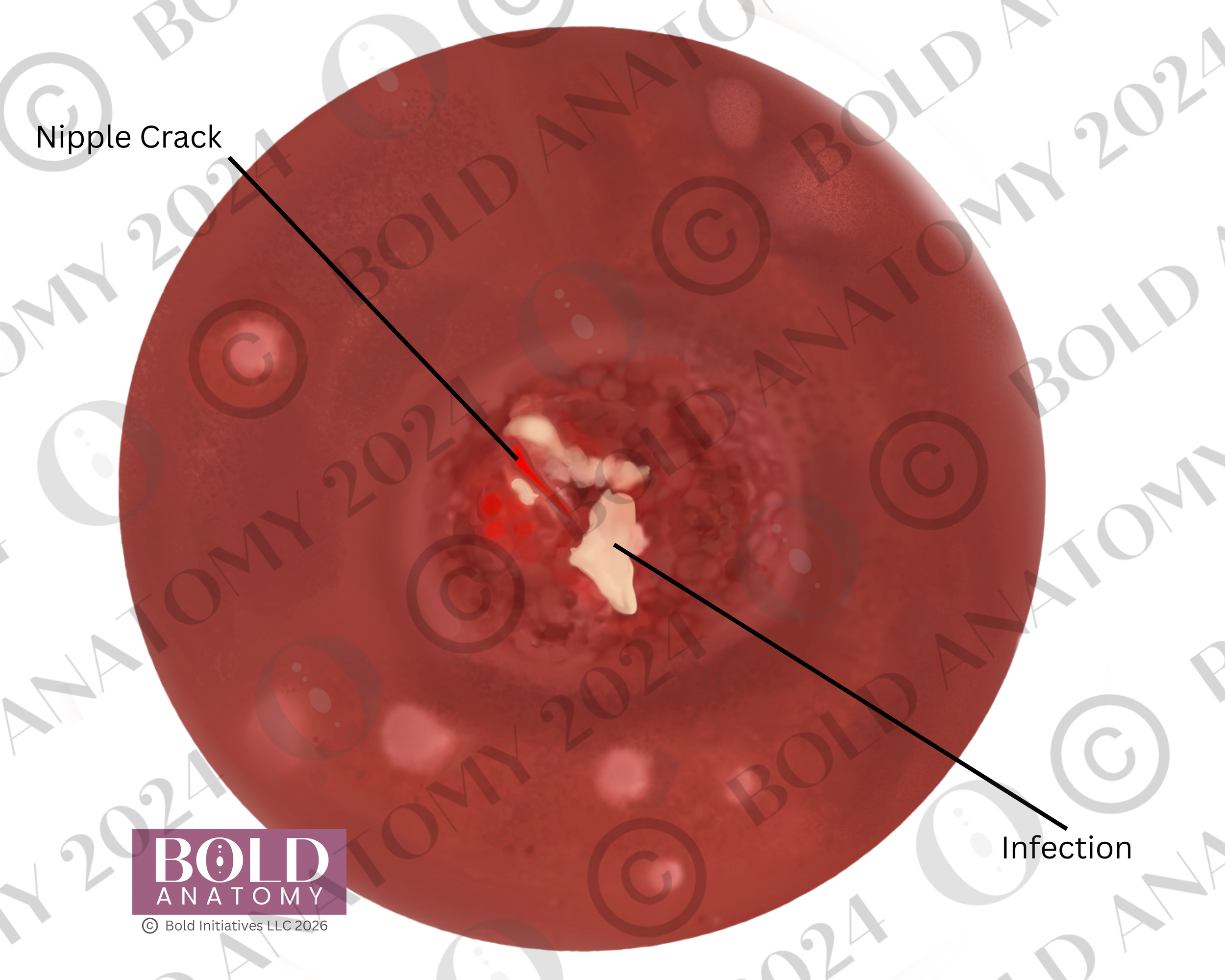 Labeled Nipple Crack, Medium Light.png