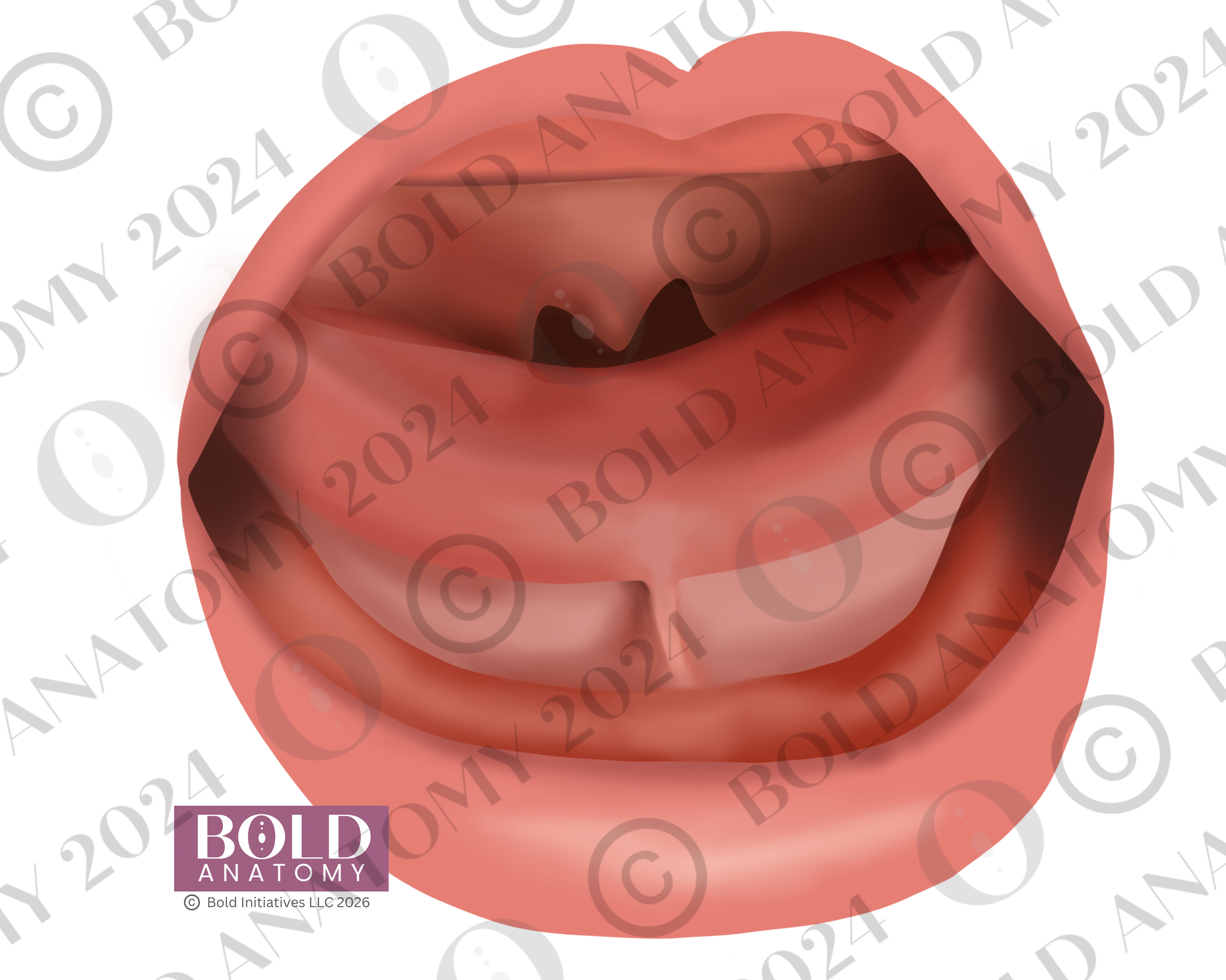 Tongue Tie Type 1