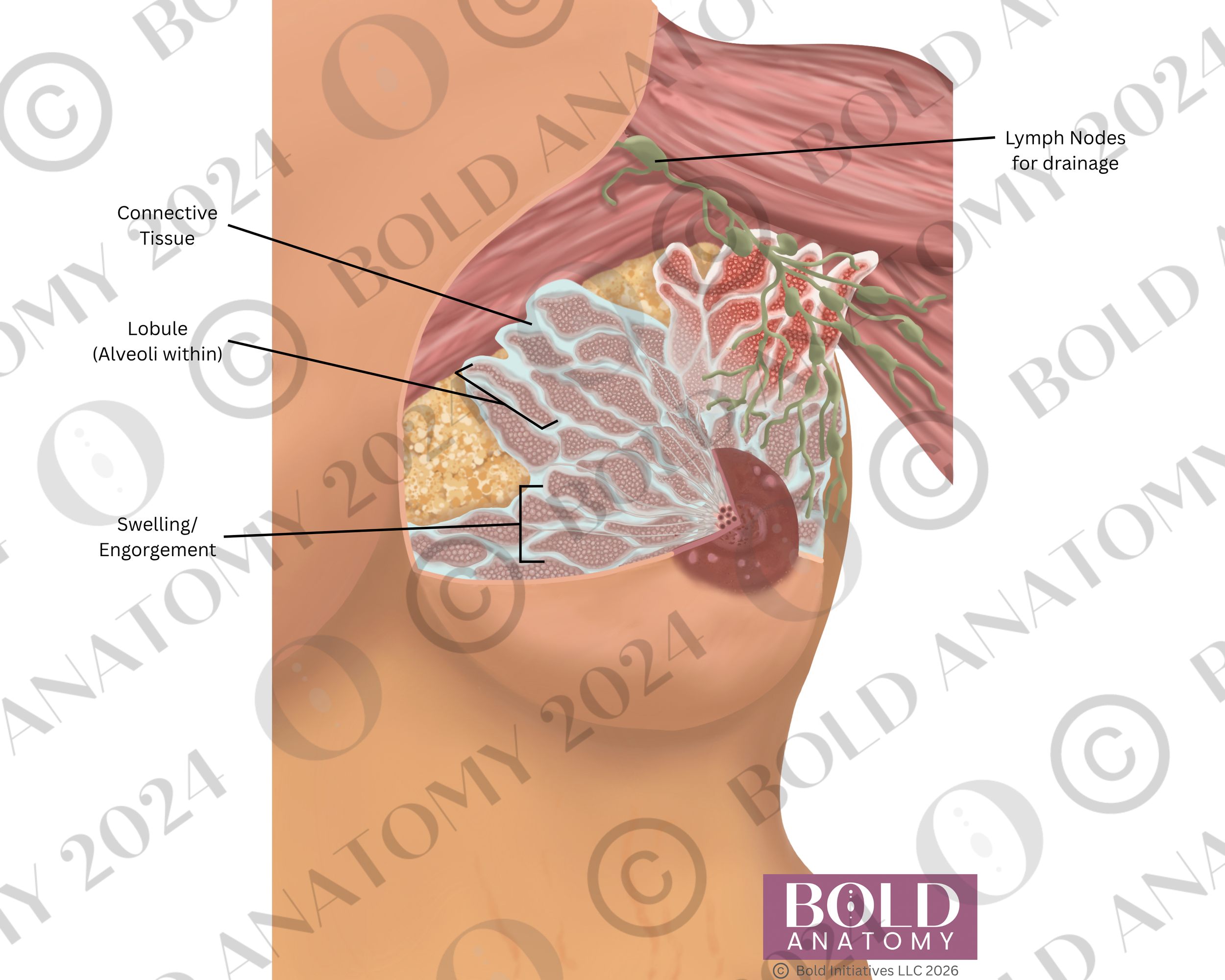 Labeled Engorgement, Medium Light.png