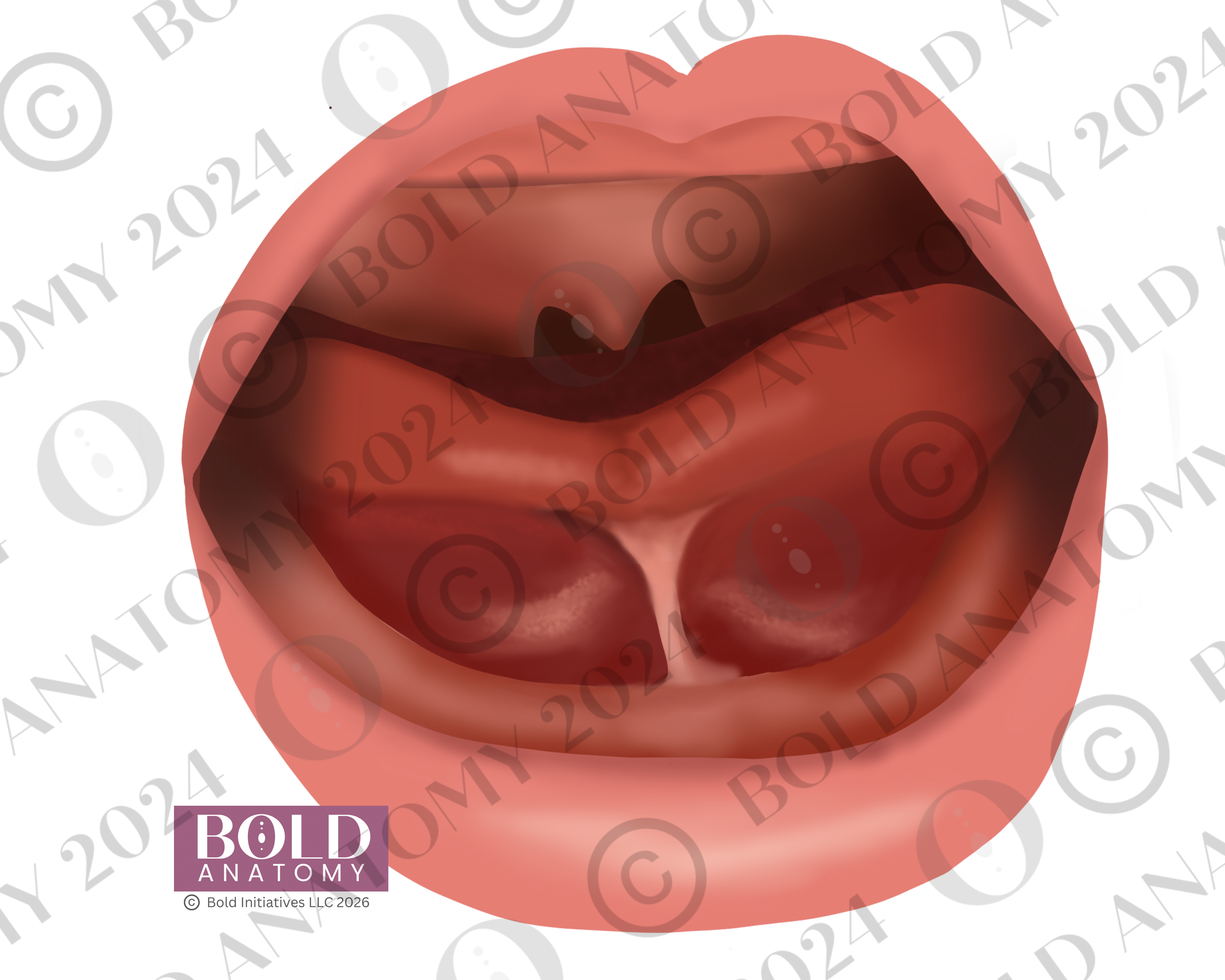 Tongue Tie Type 2.png