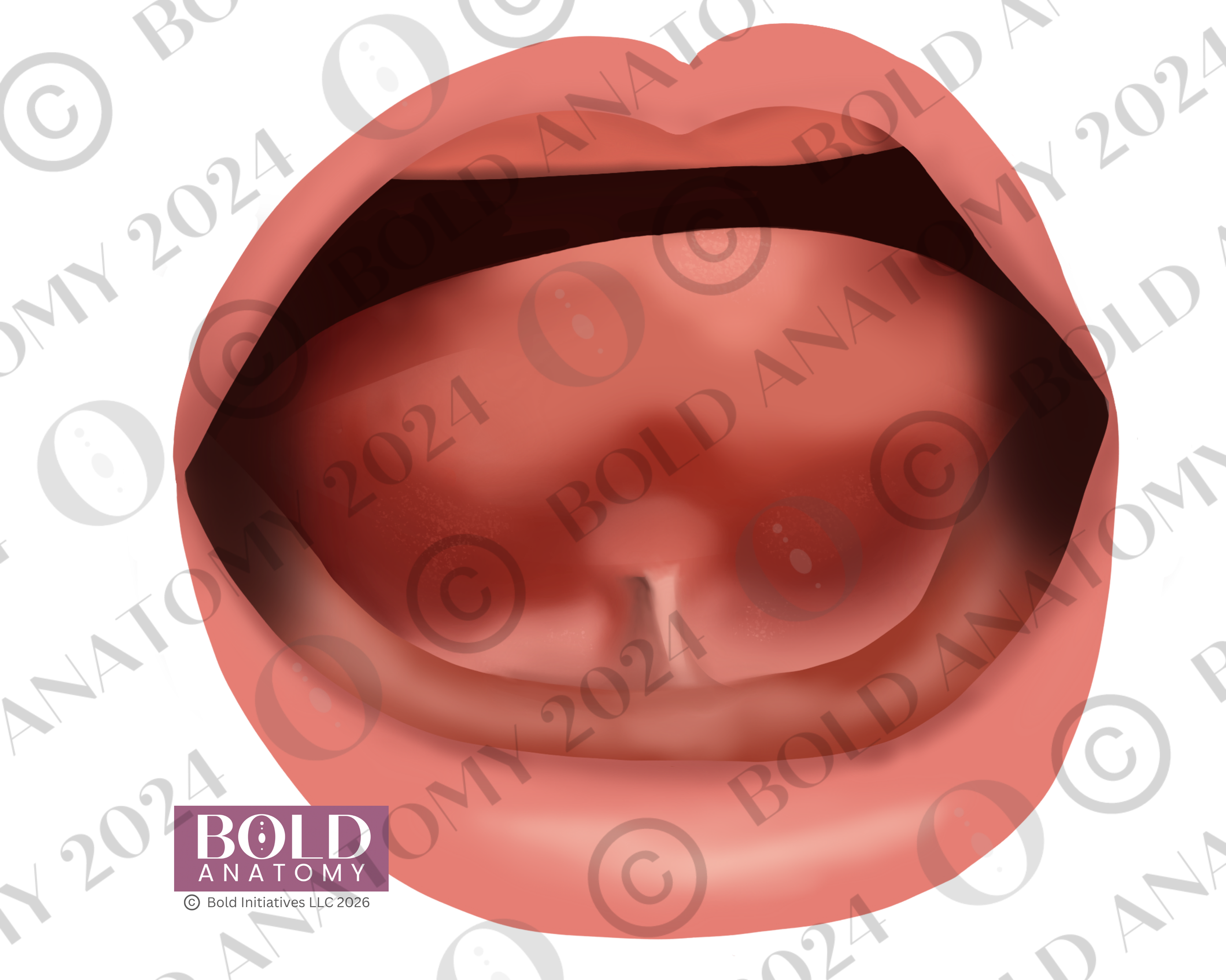 Tongue Tie Type 3.png