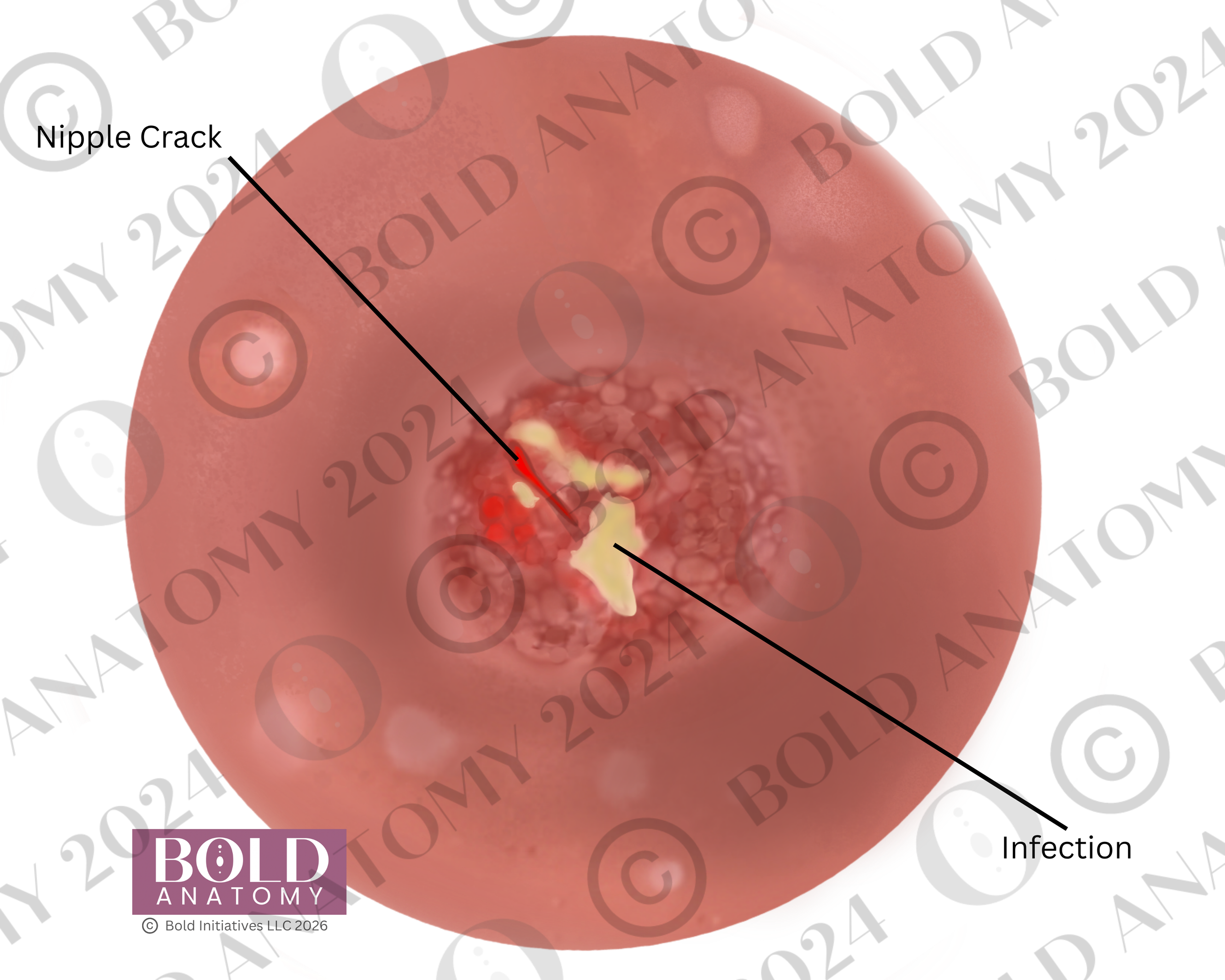 Labeled Nipple Crack, Lightest.png