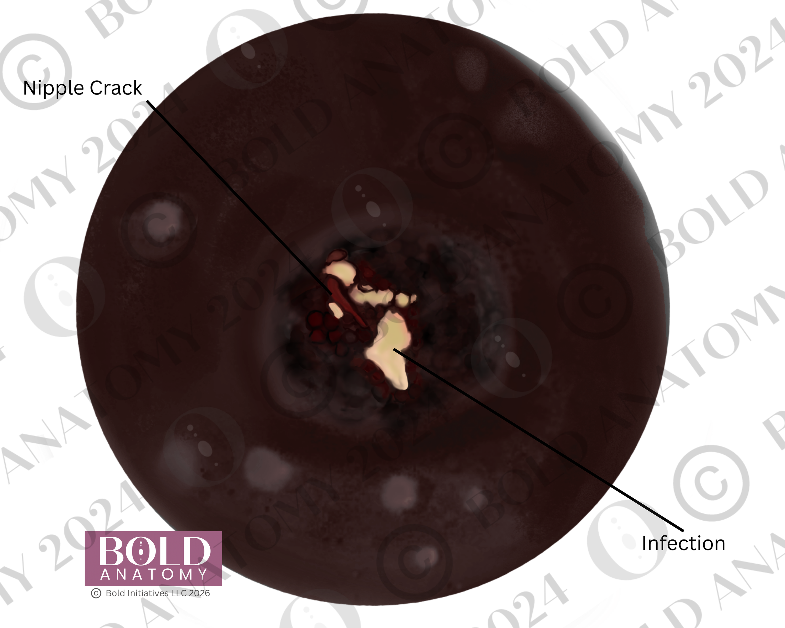 Labeled Nipple Crack, Darkest.png