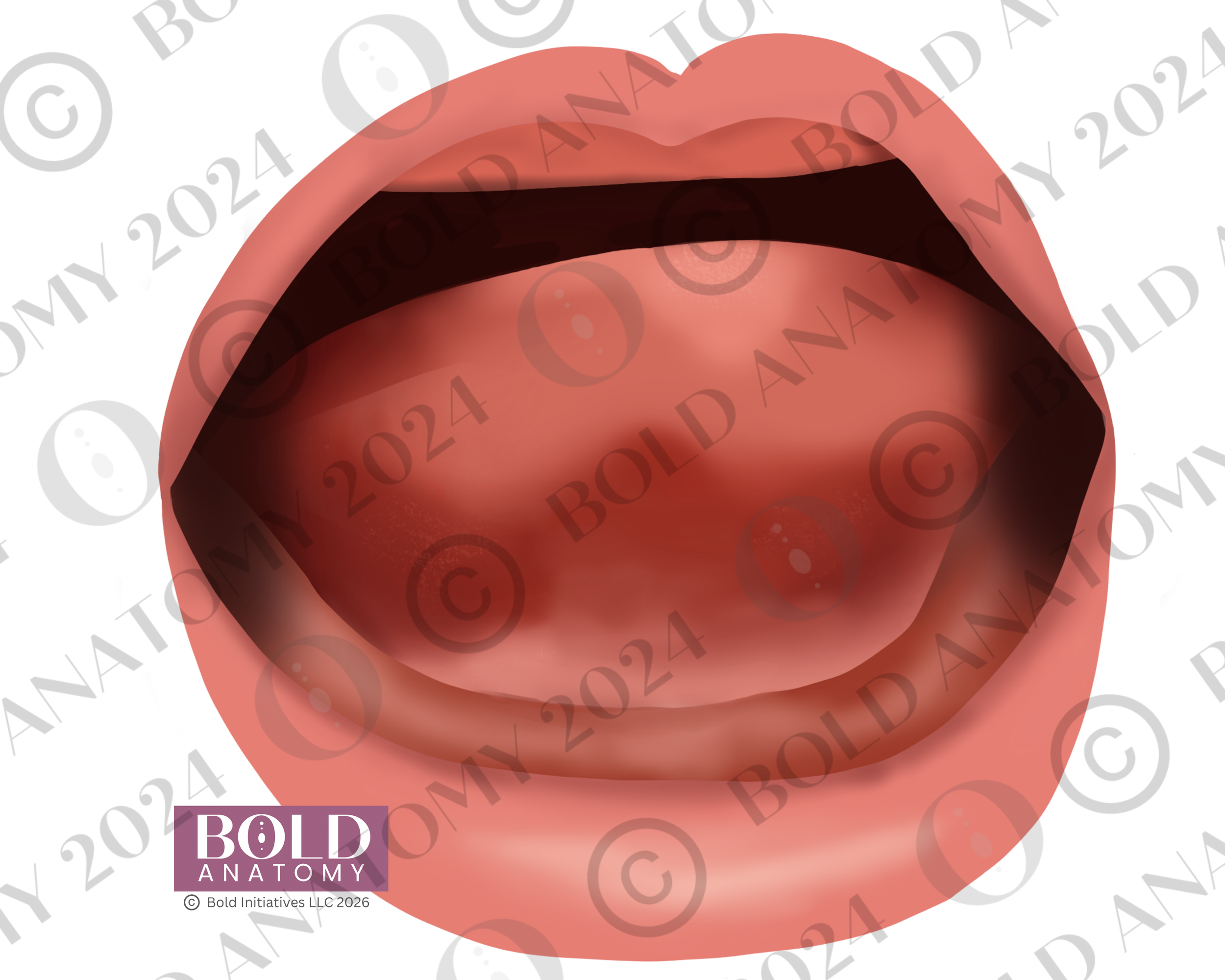 Tongue Tie Type 4