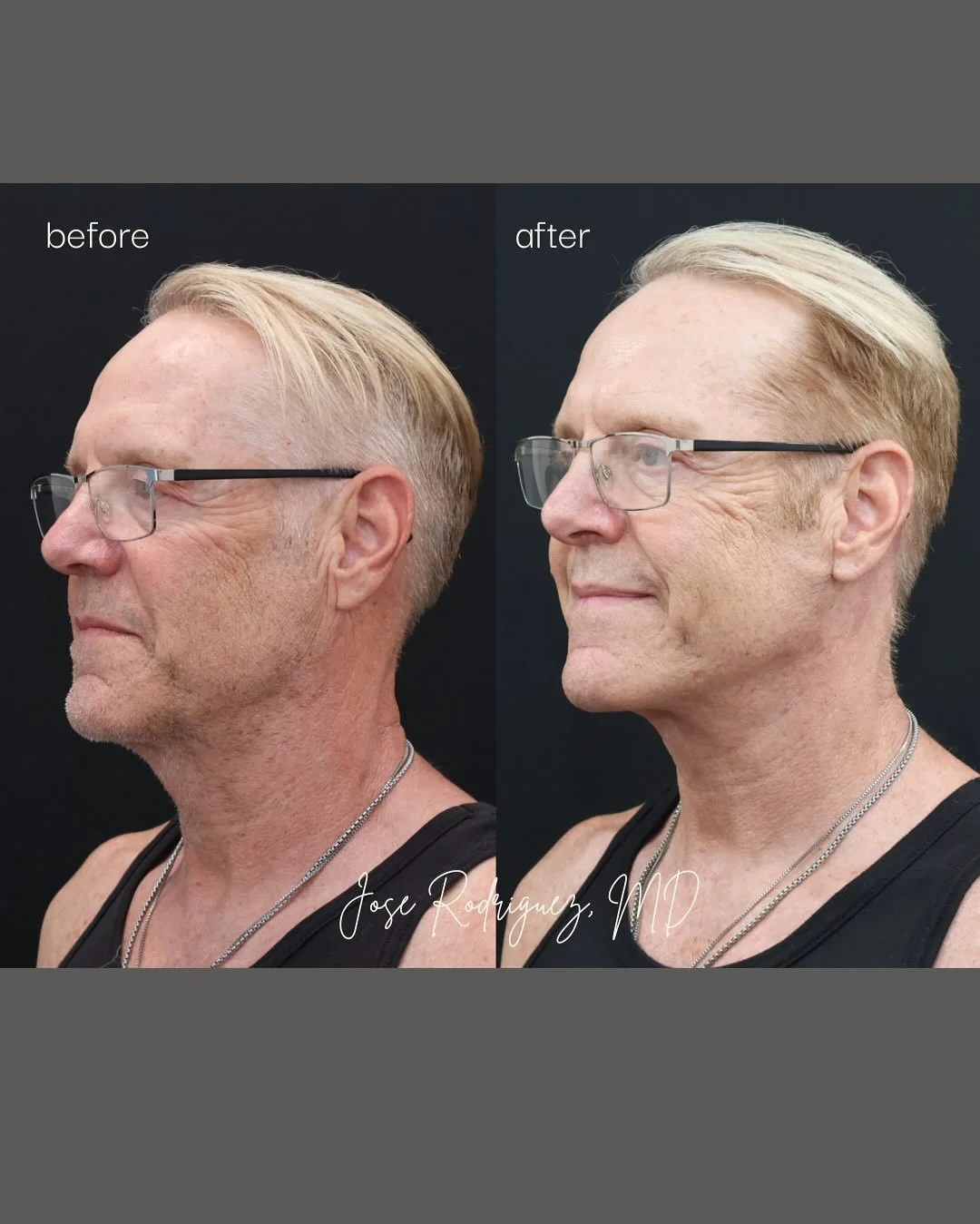 This amazing patient of mine had a Deep plane neck lift.  I really love this procedure especially in men. It&rsquo;s really powerful in reshaping and rejuvenating the neck and lower face. He is killing it his summer with that neck!!!

#NeckLift #Neck