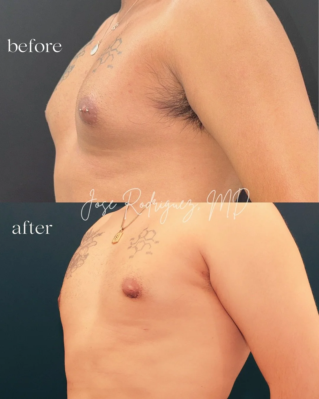Gynecomastia surgery, this is male breast reduction surgery to give the patient a stronger, more sculpted chest contour and the confidence to go shirtless with ease.

This patient already had great structure, and with a small incision along the borde