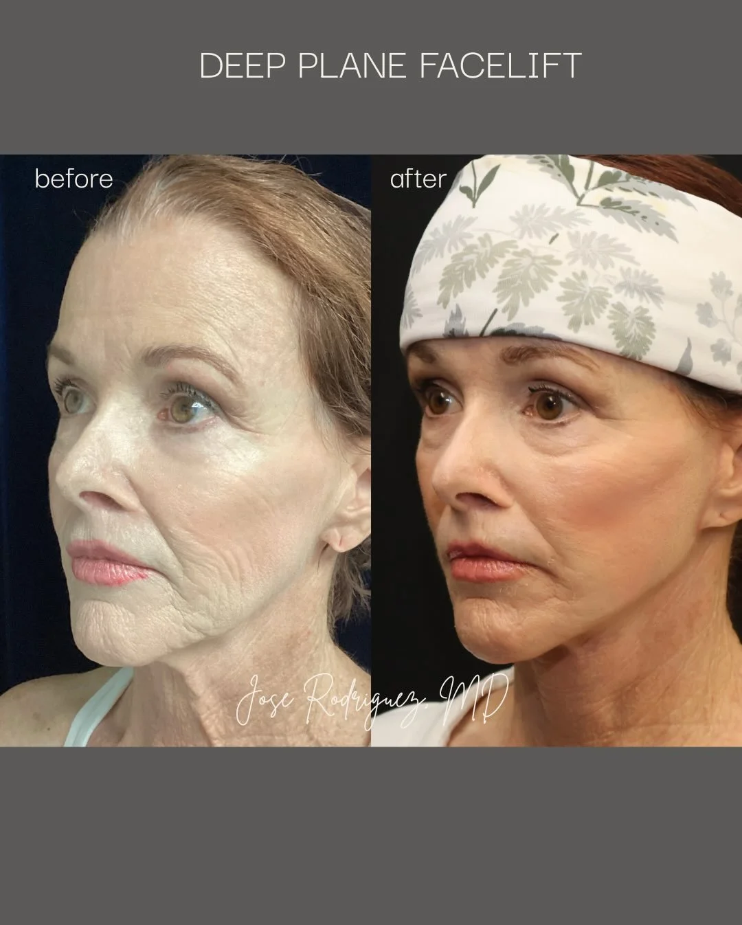 This beautiful patient chose a deep plane face and neck lift with laser resurfacing to feel like the best version of herself for her son&rsquo;s wedding. 

Seeing her radiate confidence, joy, and renewed energy on such a meaningful day is exactly why