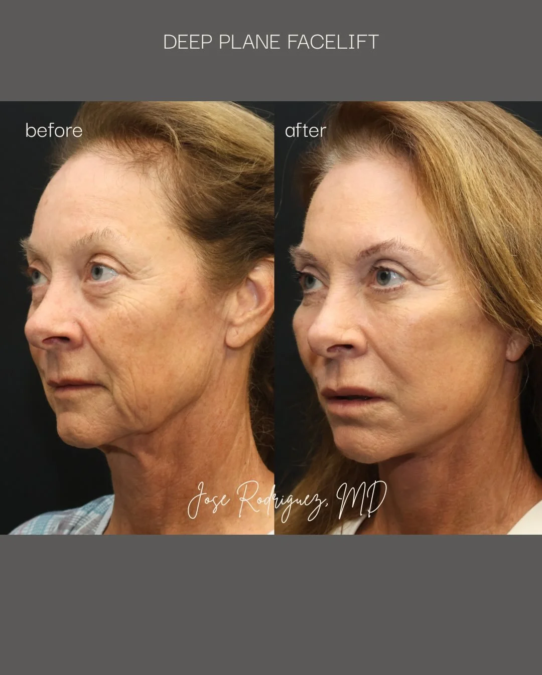 A beautiful, natural refresh 

This wonderful patient of mine underwent a deep plane facelift and neck lift, along with facial fat grafting using micro- and nanofat to the under-eye area, nasolabial folds, upper lip, and cheeks.

I use a composite de