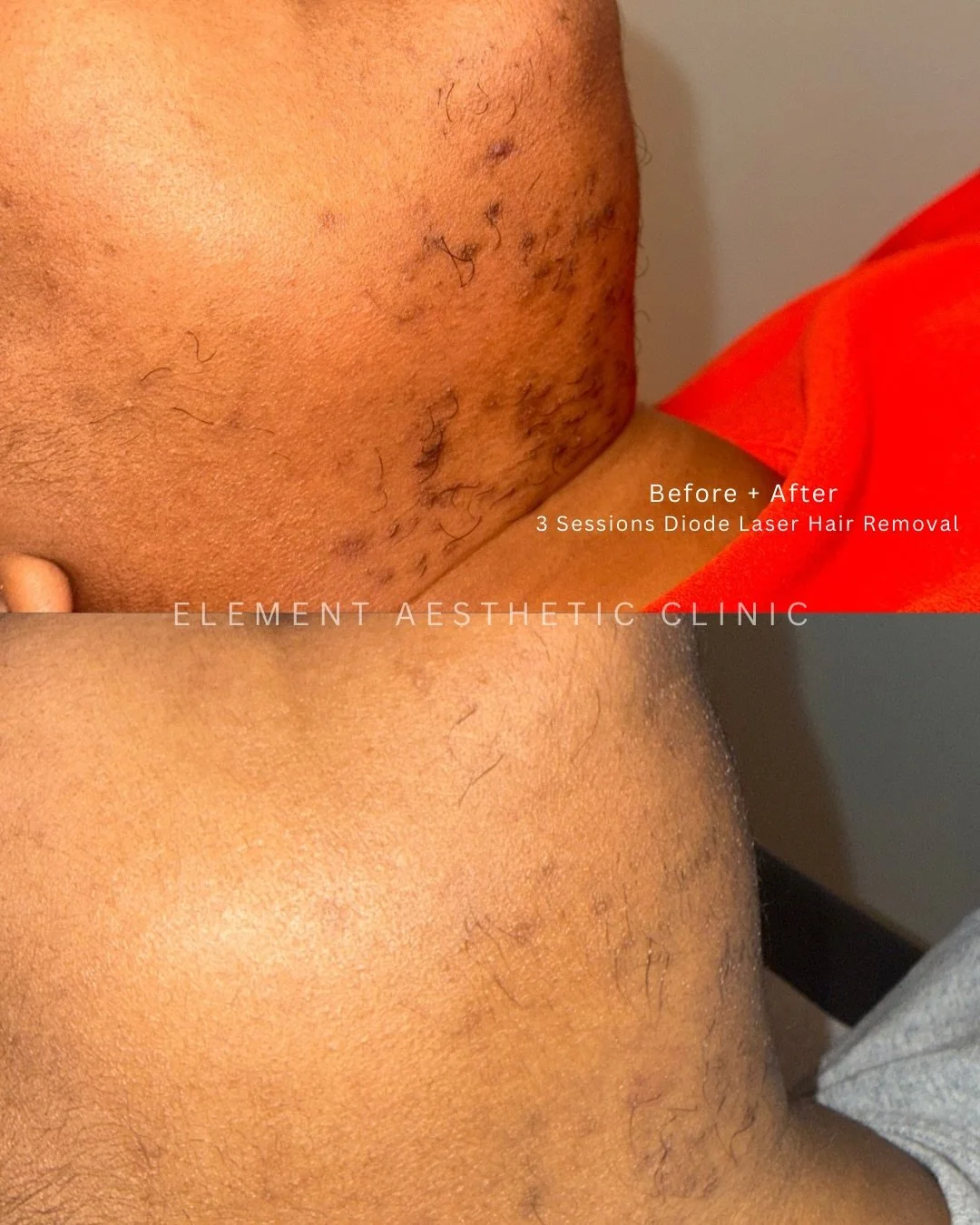 She used to laugh with her head down.
By her third laser session, she looked at me and said,
&ldquo;Jannah&hellip; I walk with my head up now.&rdquo; 🥹

This is what happens when laser isn&rsquo;t just about hair&mdash;it&rsquo;s about confidence, c