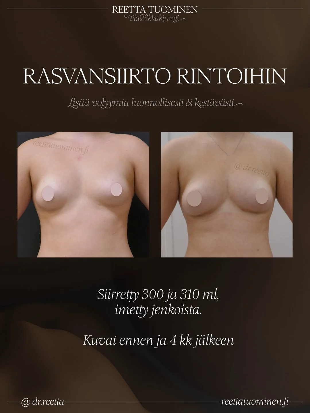 Oman rasvan siirto rintoihin, ennen ja jälkeen kuvat