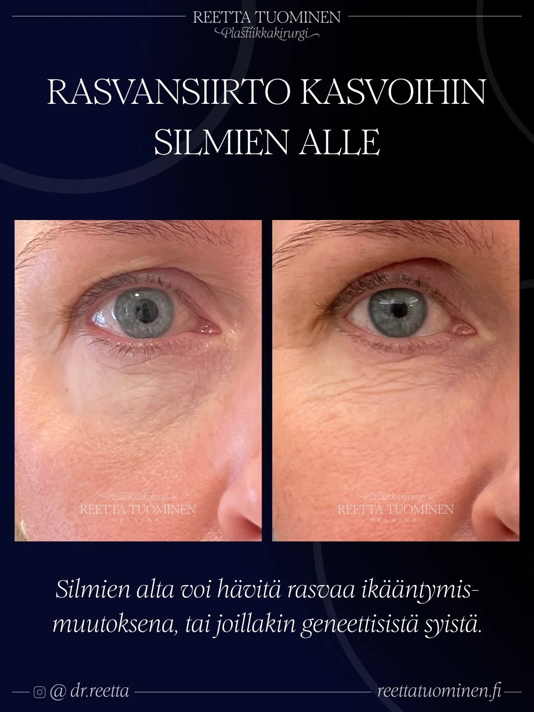 Rasvansiirto kasvoihin silmien alle ennen ja jälkeen kuvat edestä
