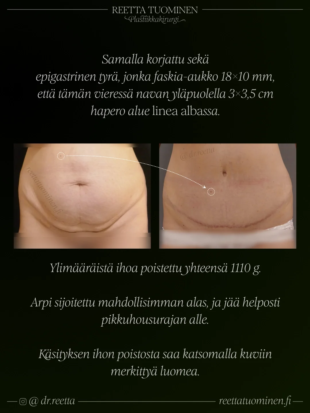 Vatsalihasten erkauman leikkaus ja HELP-abdominoplastia