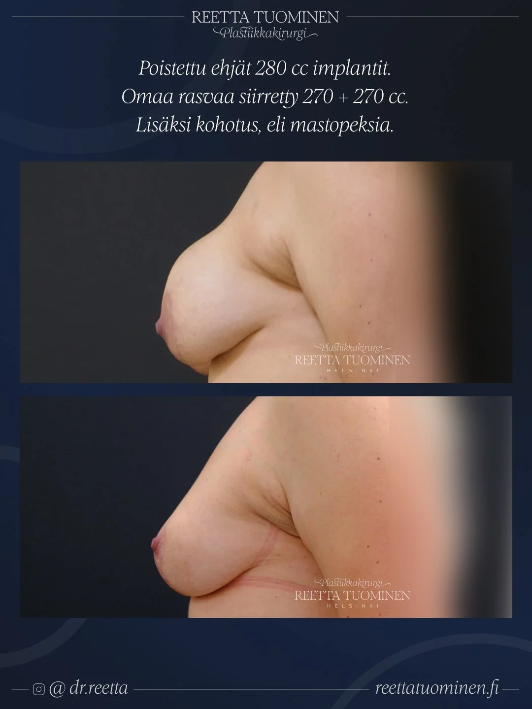Rintaimplanttien poisto, kohotus ja rasvansiirto