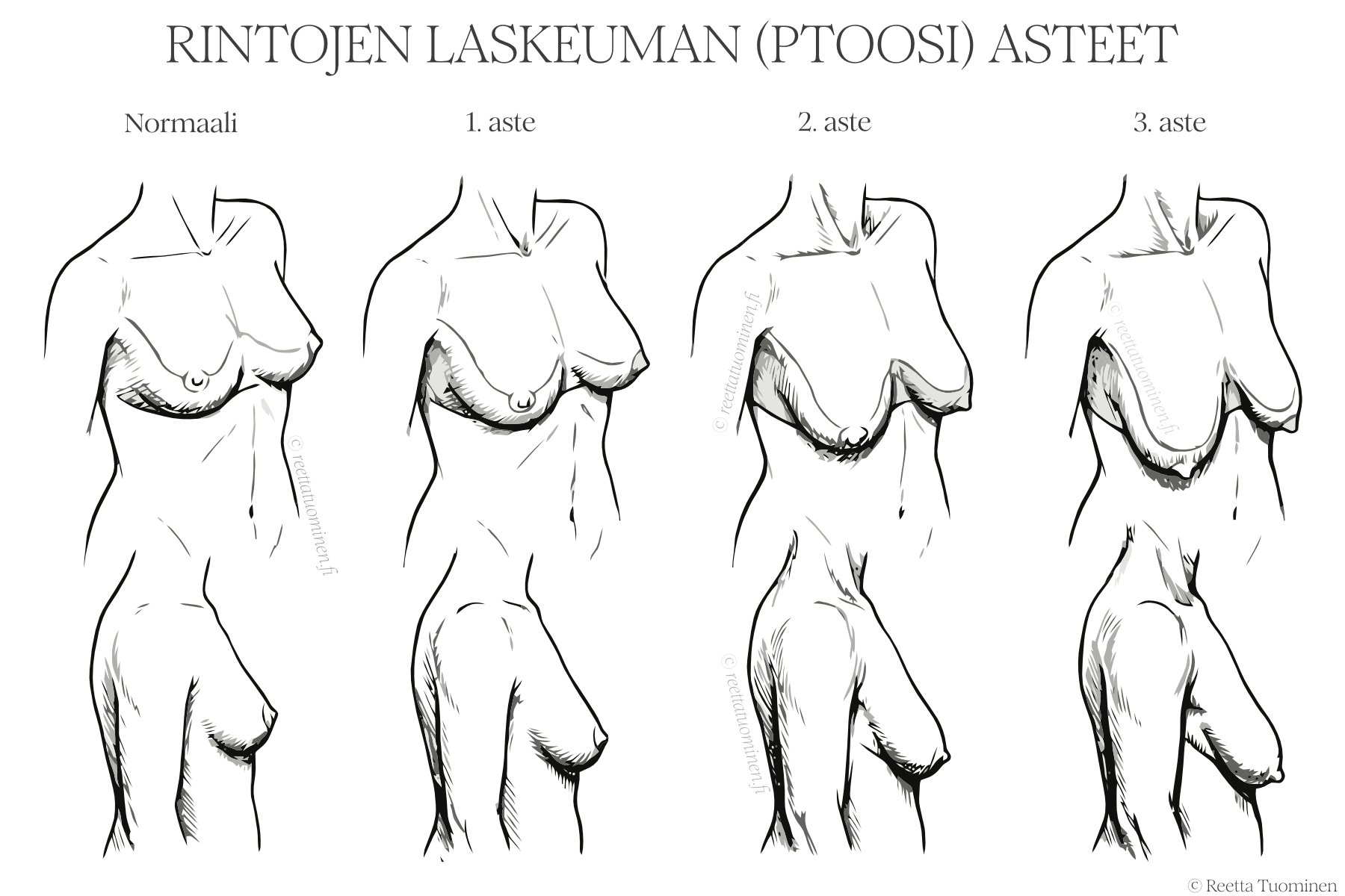 Rintojen roikkumisen, laskeuman, eli ptoosin eri asteet